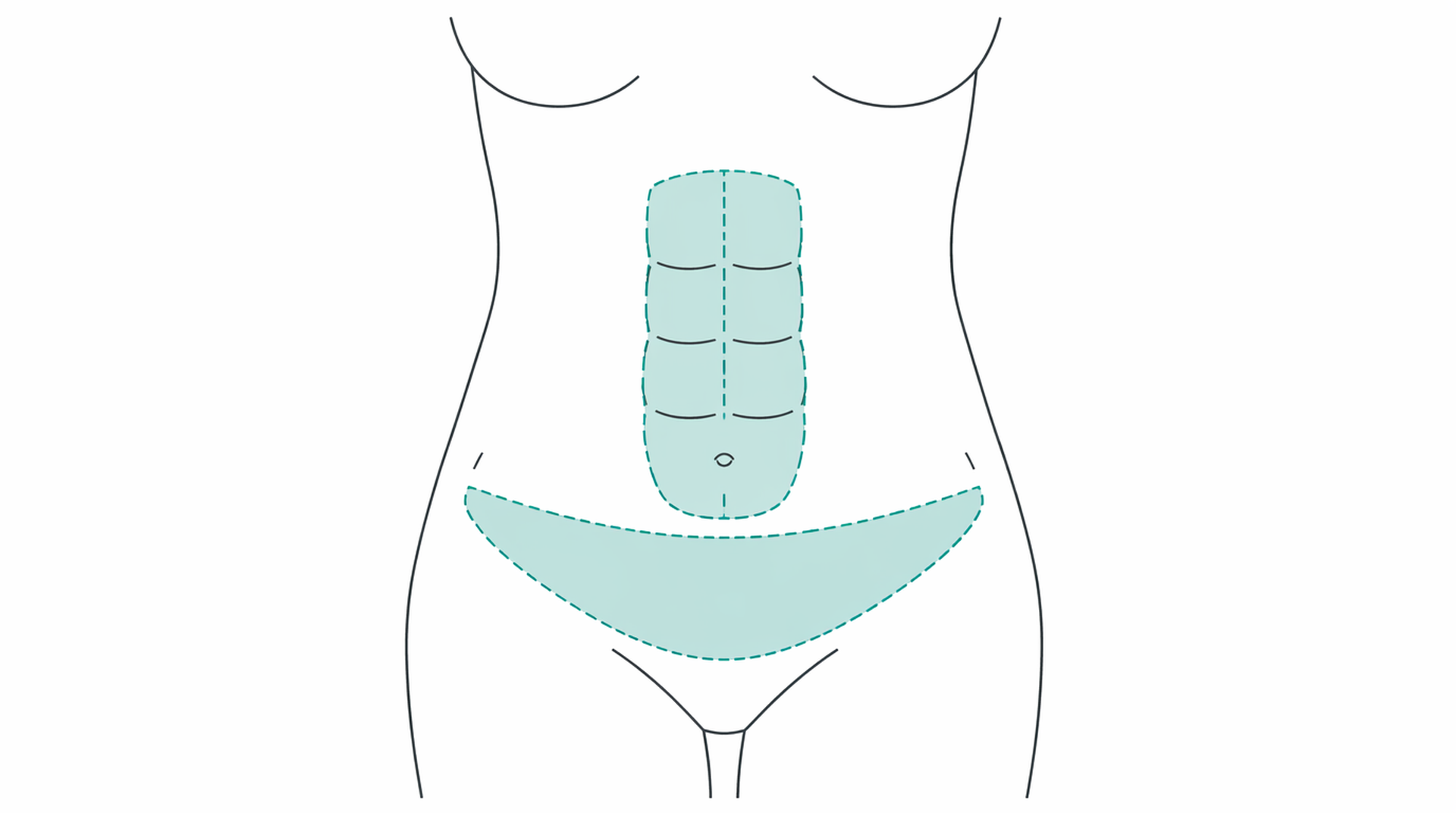 Medical line illustration of abdominoplasty body contouring for Arm lift (brachioplasty).