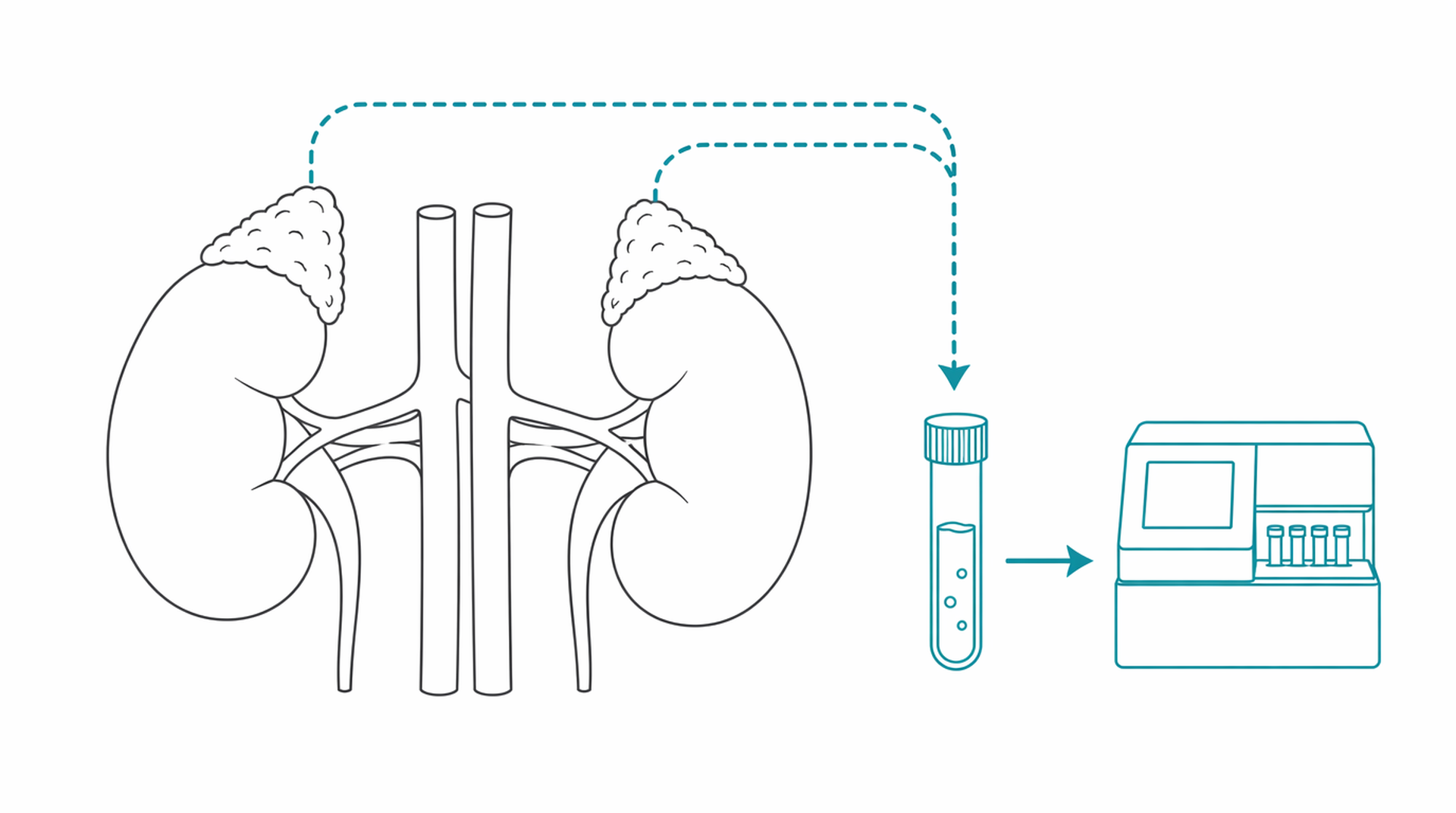 Medical line illustration of adrenal gland disorder for Addison's disease treatment.