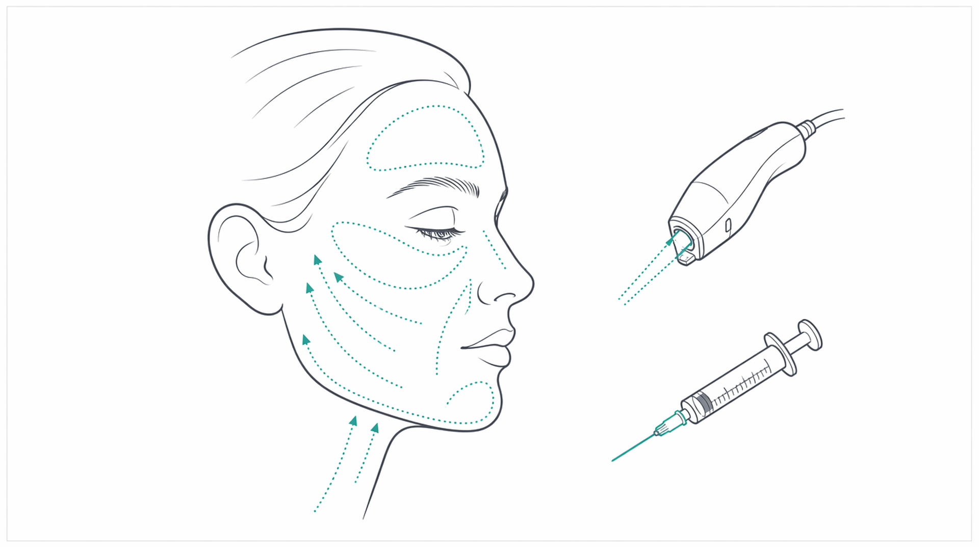 Medical line illustration of aesthetic laser injectable skin treatment for Lip augmentation (lip fillers).