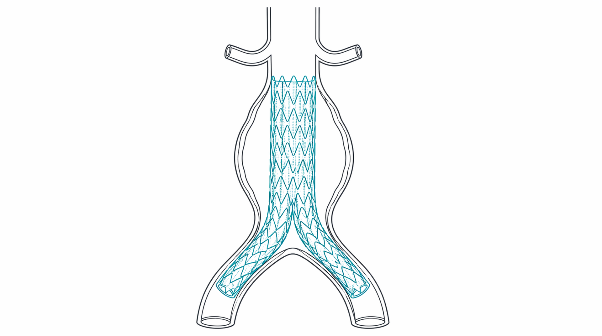 Medical line illustration of aortic aneurysm and stent graft for Endovascular aneurysm repair (EVAR).