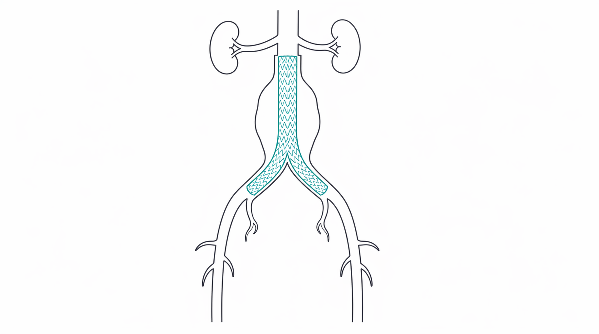 Medical line illustration of aortic aneurysm arterial surgery for Open repair of abdominal aortic aneurysm.