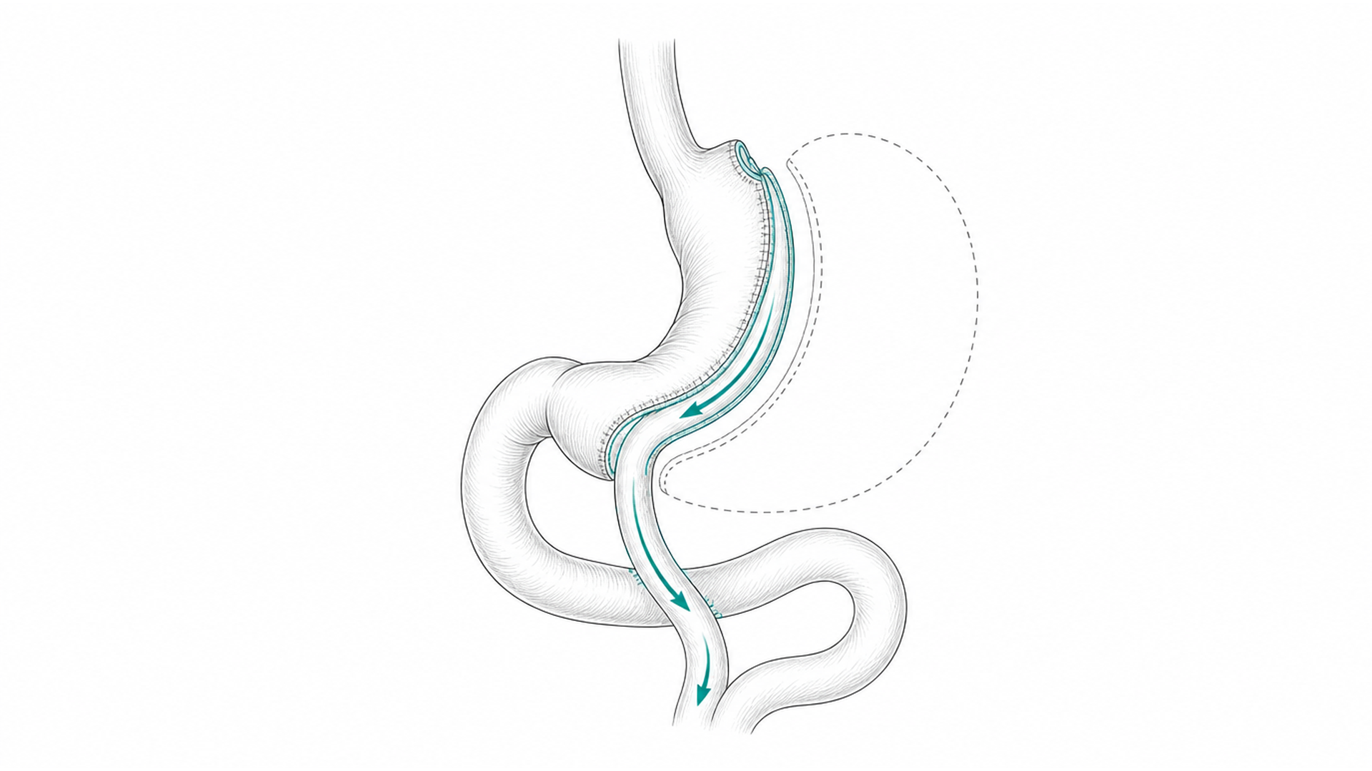 Medical line illustration of stomach anatomy and bariatric surgery planning for Gastric balloon insertion.