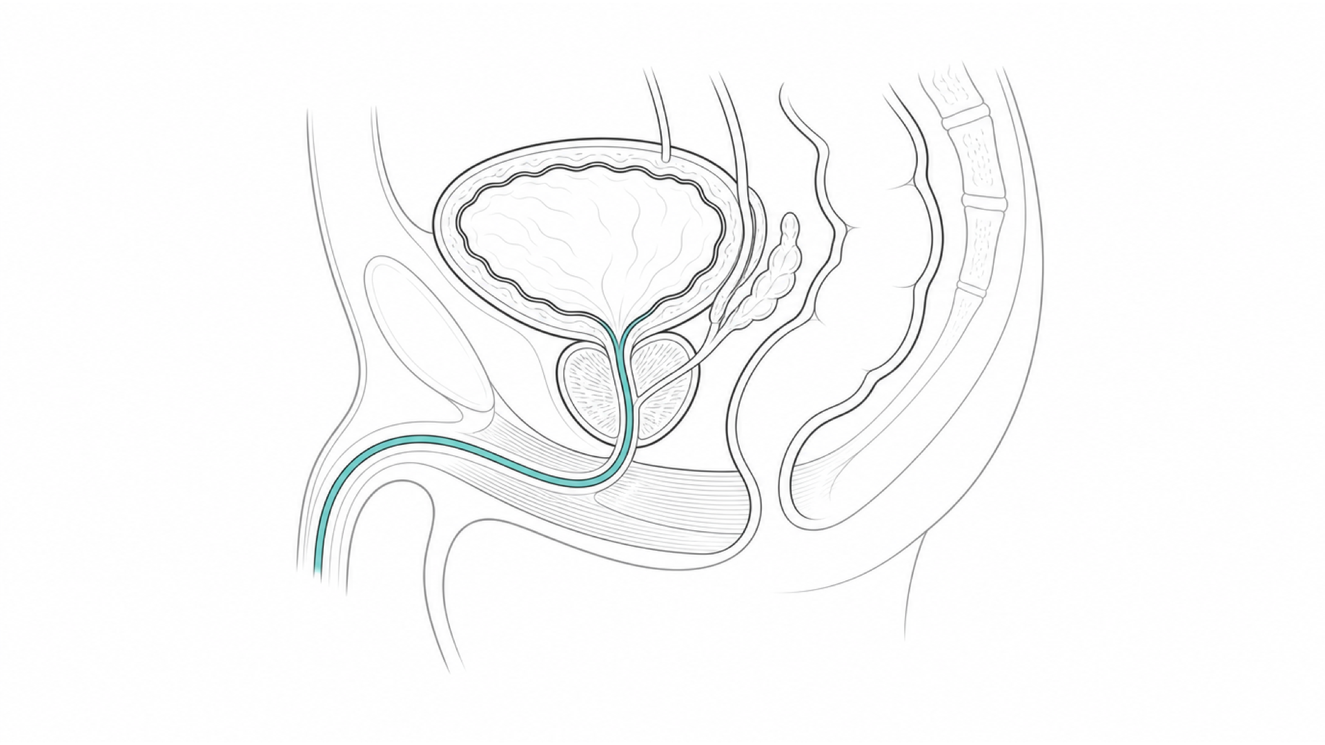 Medical line illustration of the bladder, prostate and male lower urinary tract for Bladder cancer surgery (cystectomy).