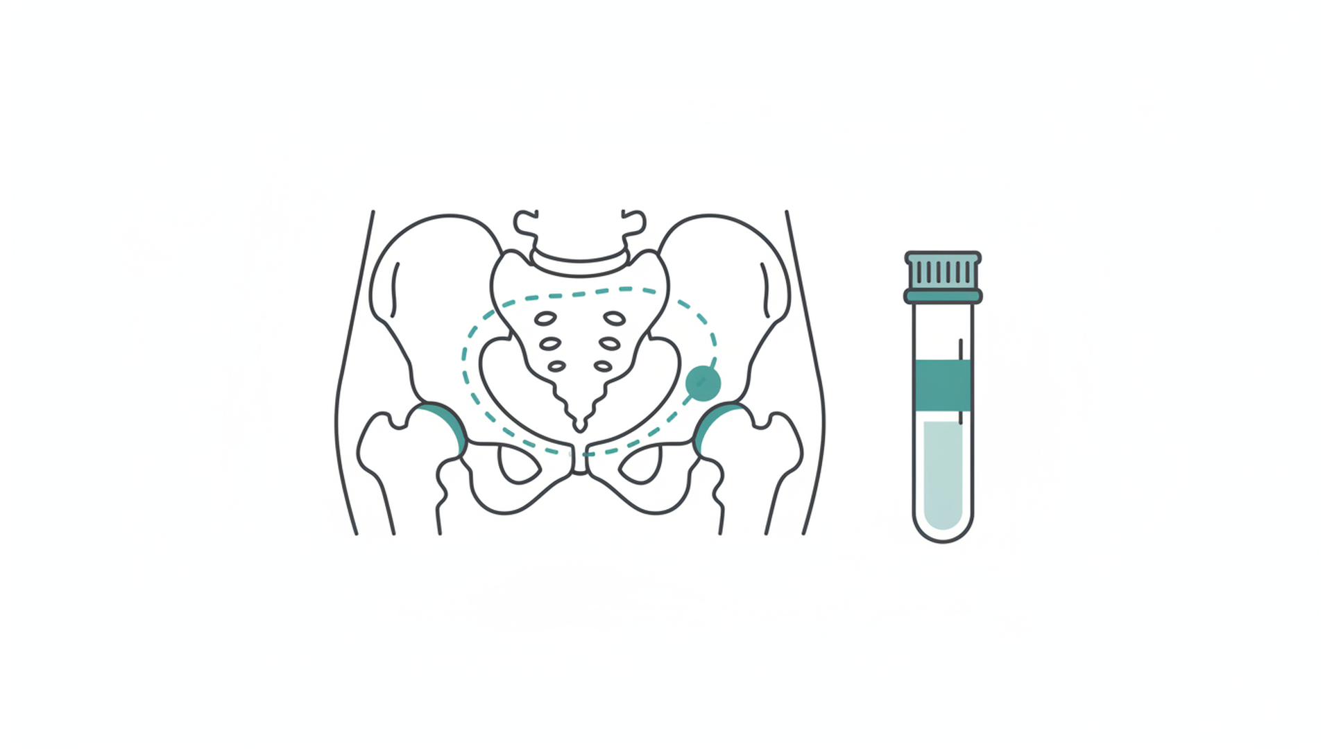 Medical line illustration of the pelvis and bone marrow sampling pathway for Bone marrow biopsy reporting.