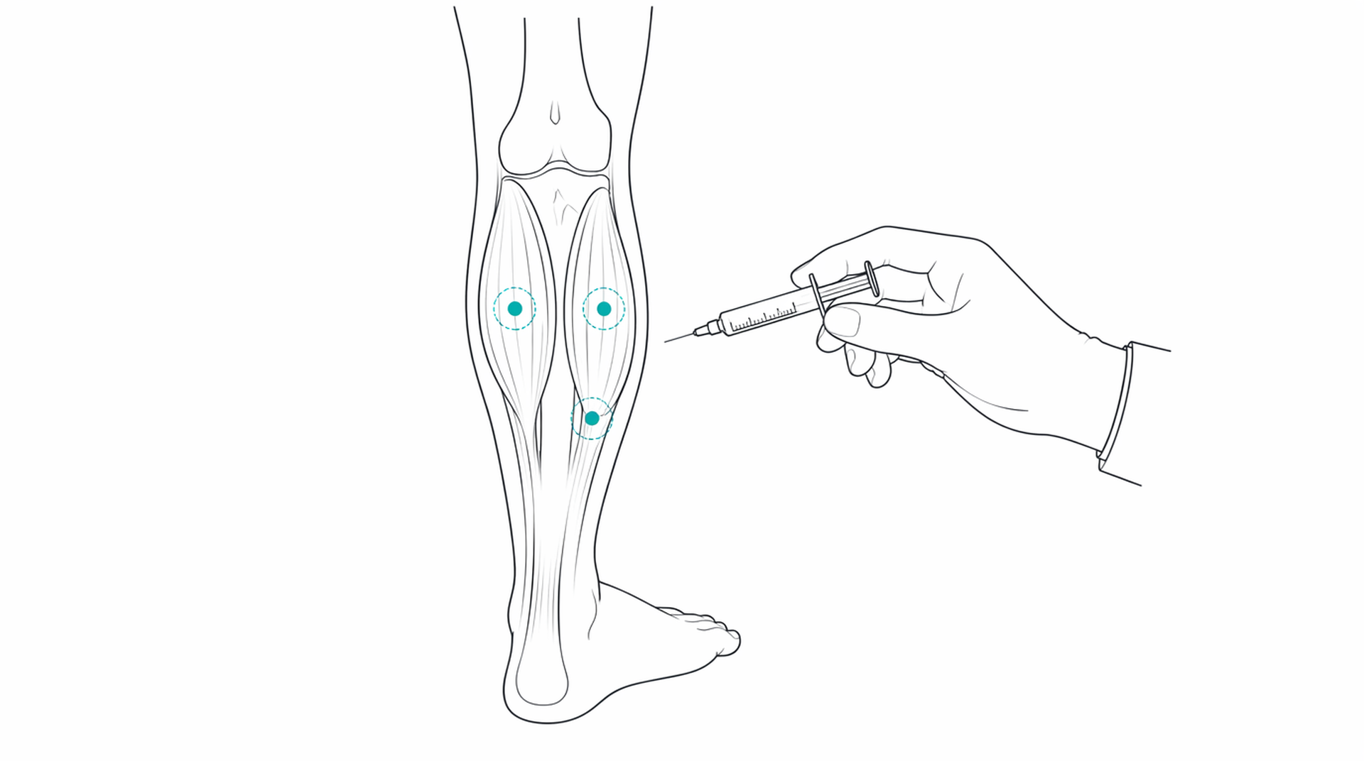 Medical line illustration of botulinum toxin spasticity dystonia for Stroke rehabilitation.
