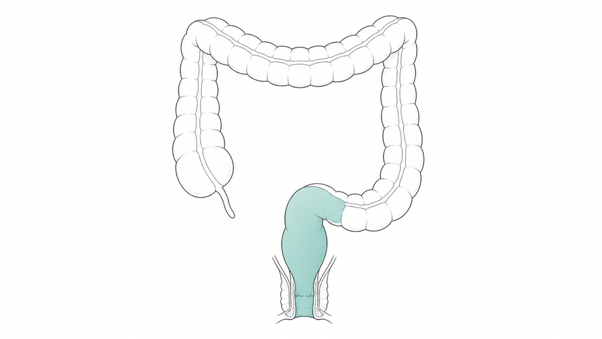 Medical line illustration of the large bowel and rectum for Constipation management (palliative care).