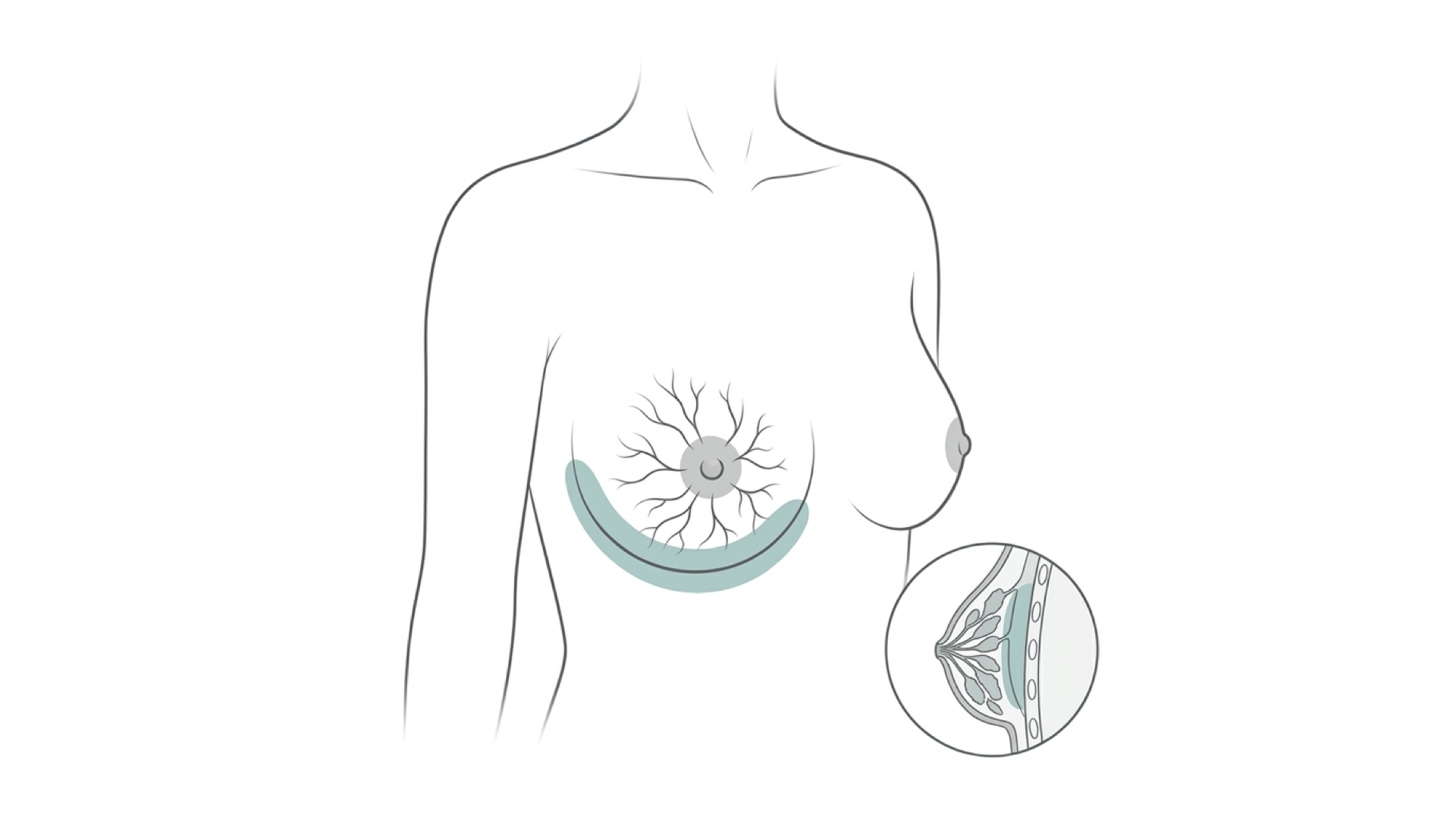 Medical line illustration of breast anatomy for Lump removal (wide local excision / lumpectomy).