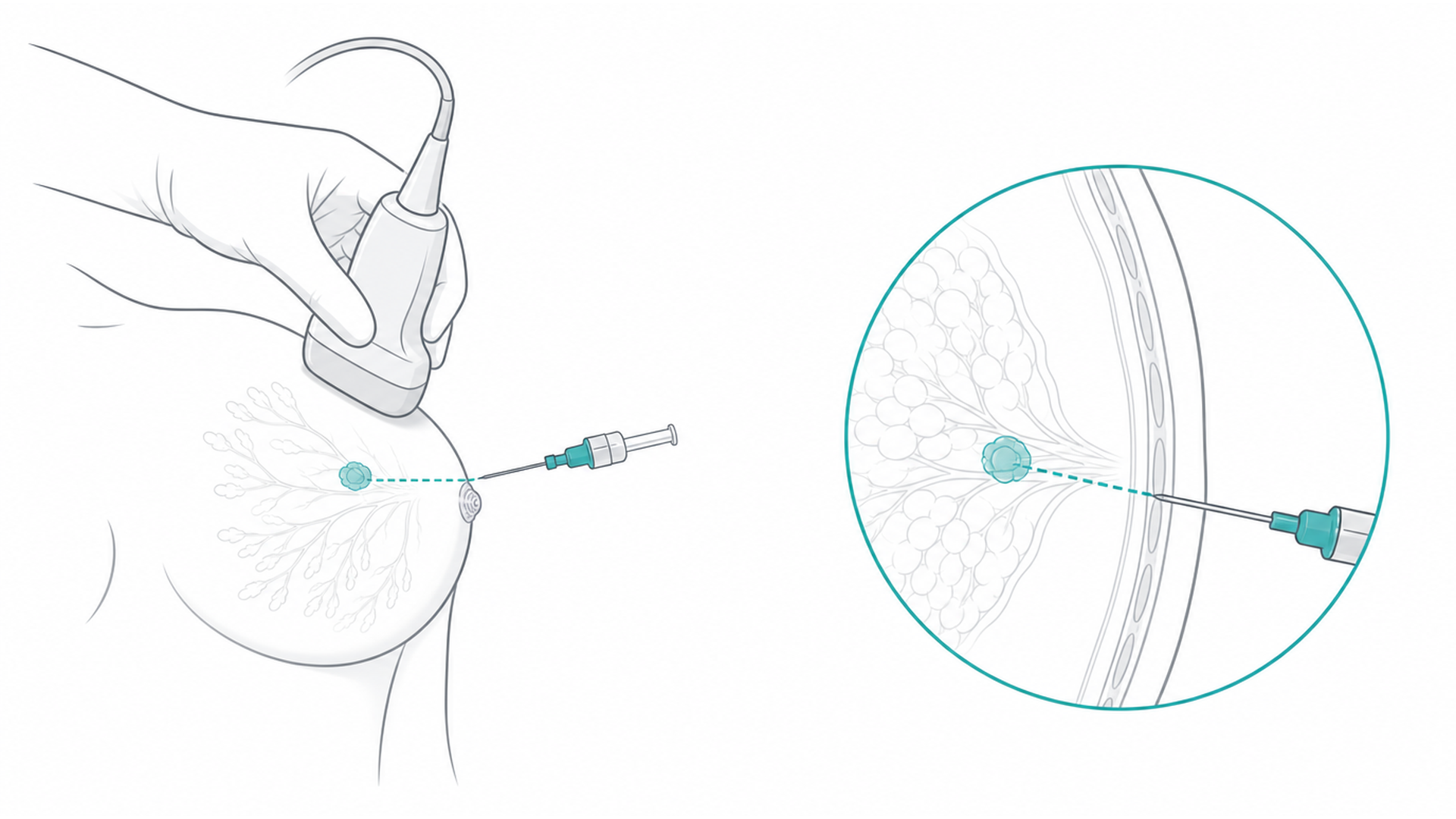 Medical line illustration of breast imaging and biopsy sampling pathway for Mammogram.