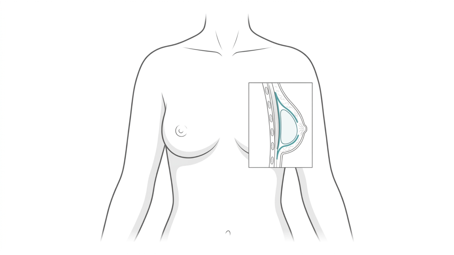 Medical line illustration of breast implant pocket anatomy for Breast enlargement.