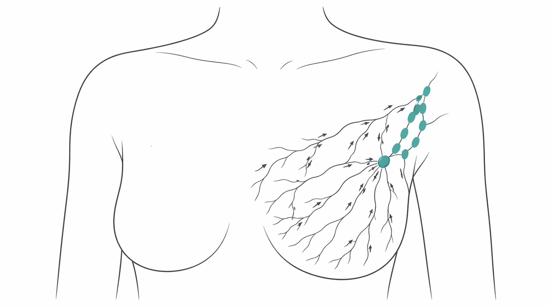 Medical line illustration of breast lymphatic drainage for Axillary lymph node clearance.