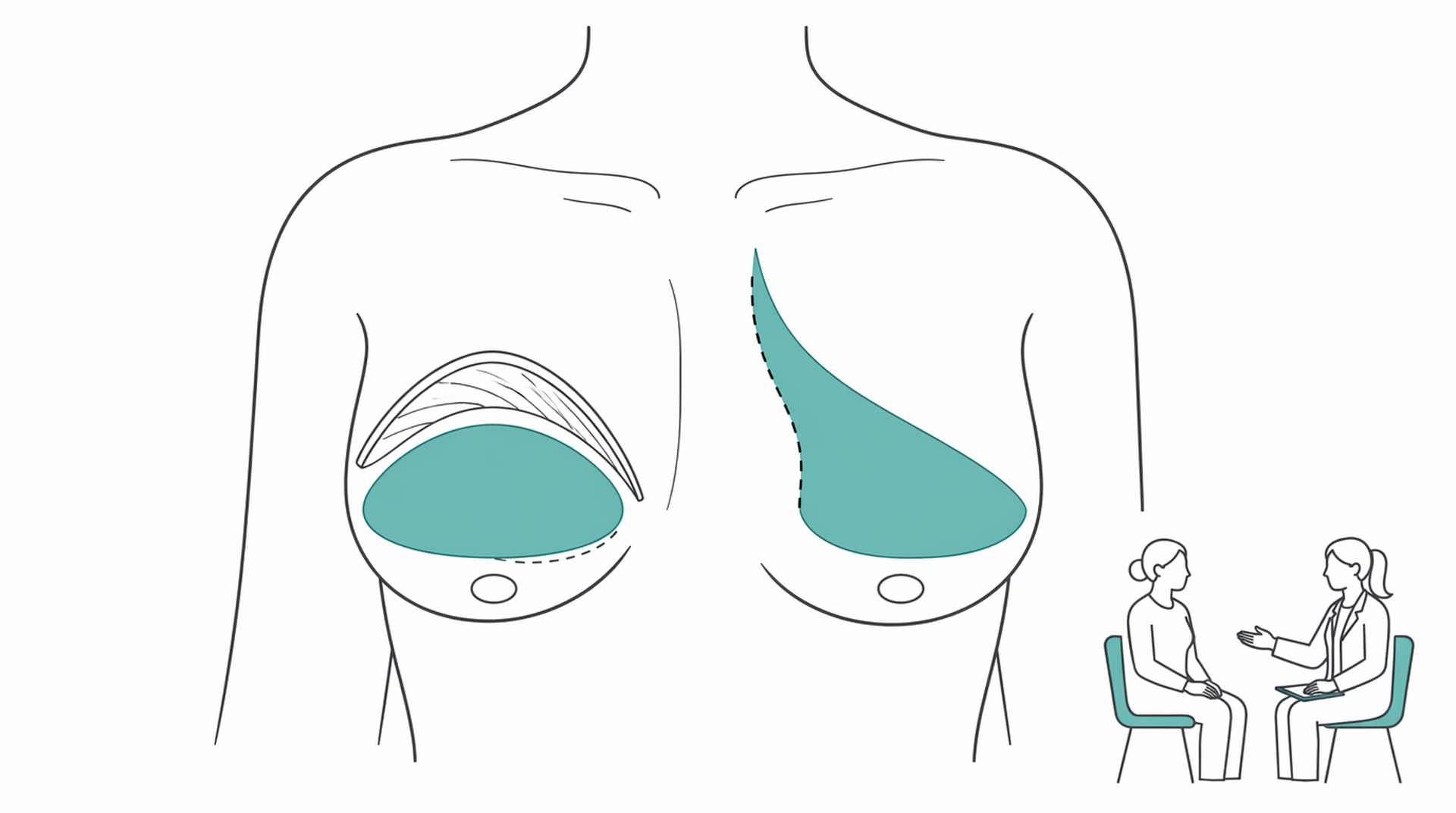 Medical line illustration of breast reconstruction for Breast reconstruction (implant).