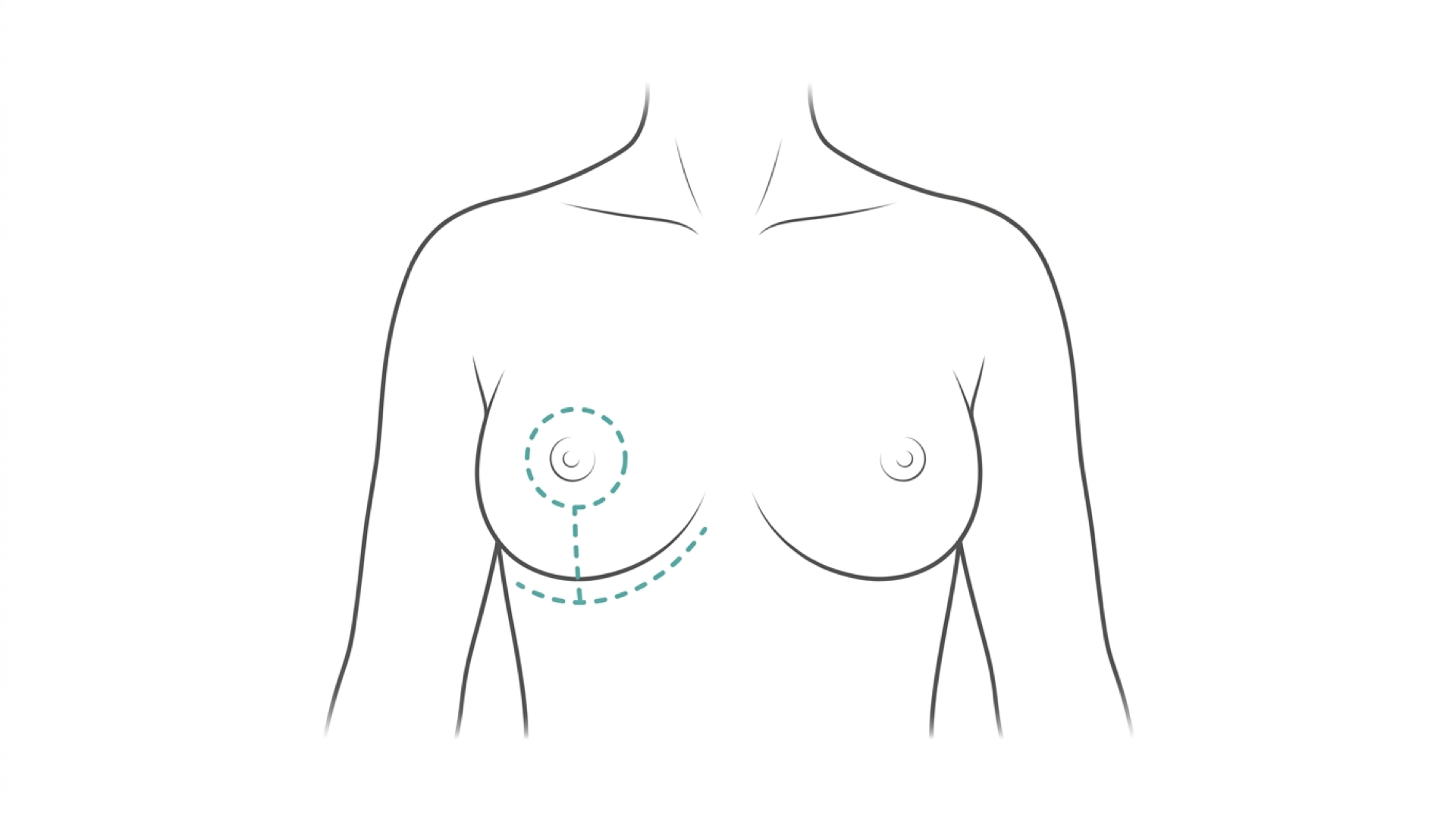 Medical line illustration of breast reduction and uplift incision patterns for Breast reduction.