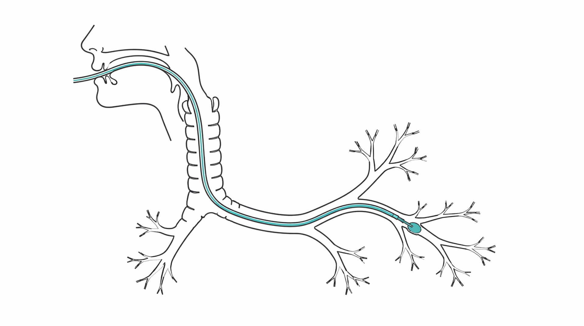 Medical line illustration of bronchoscopy airway biopsy for Bronchoscopy.