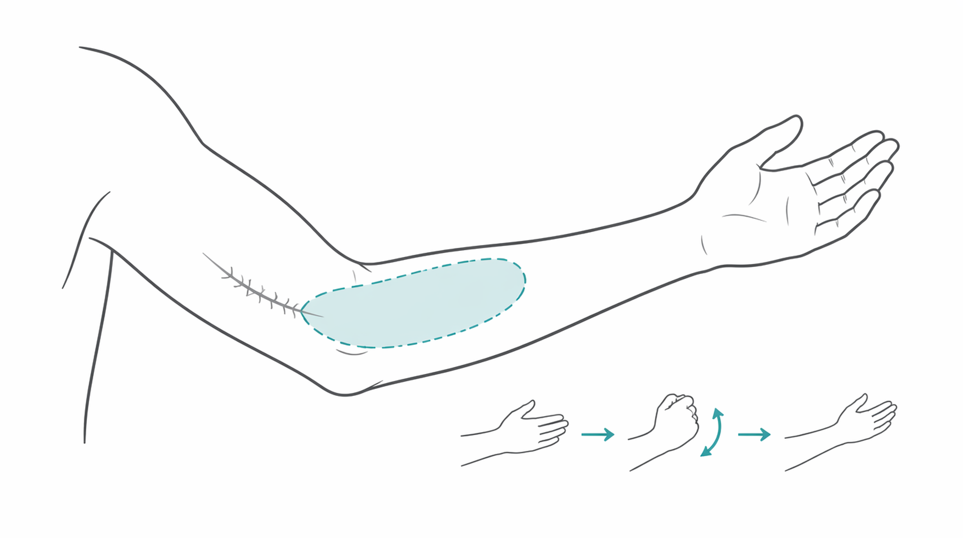 Medical line illustration of burns reconstruction for Burns reconstruction.
