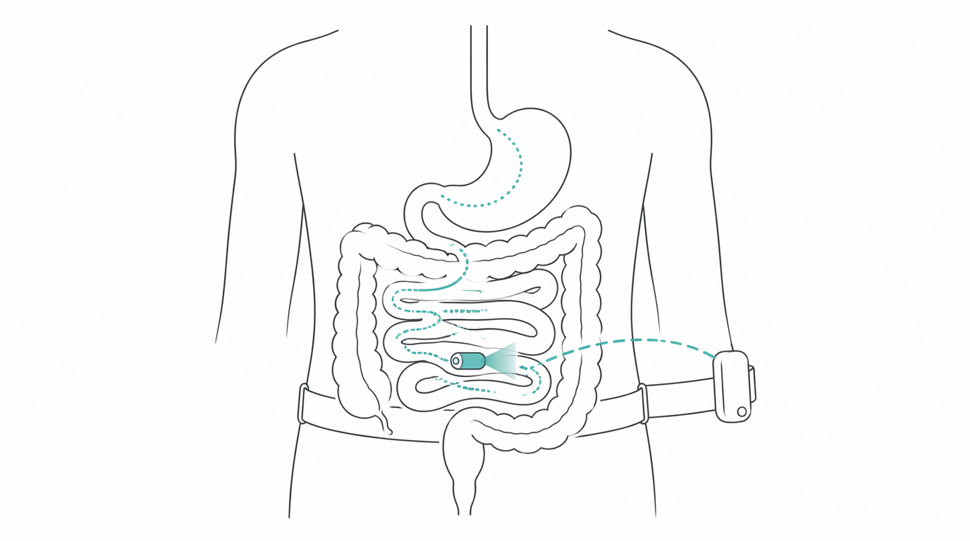 Medical line illustration of capsule endoscopy for Capsule endoscopy.