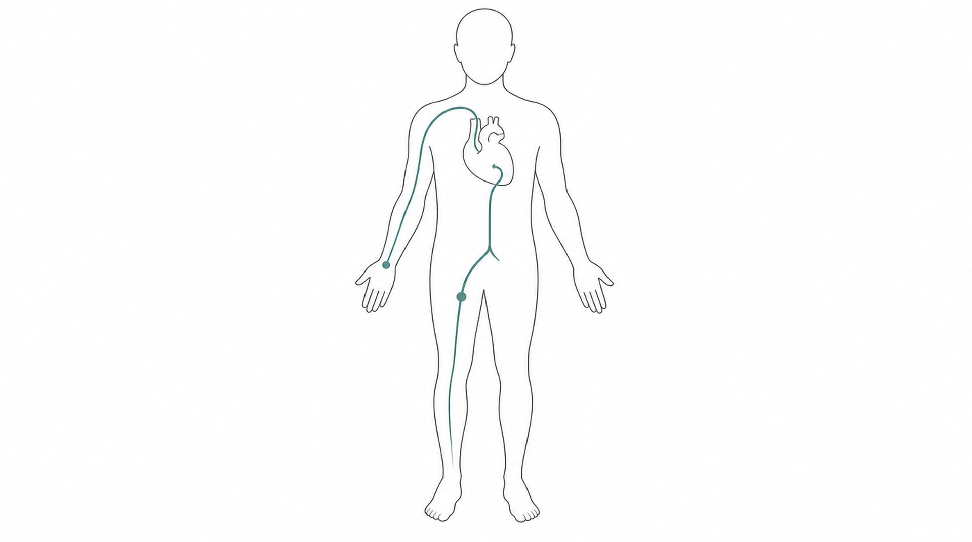 Medical line illustration of cardiac catheterisation pathway for Left atrial appendage closure.
