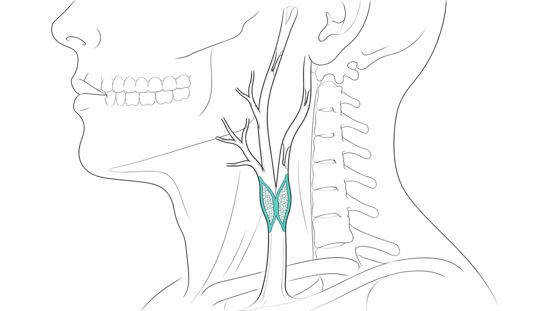 Medical line illustration of carotid artery and neck vessels for Carotid endarterectomy.