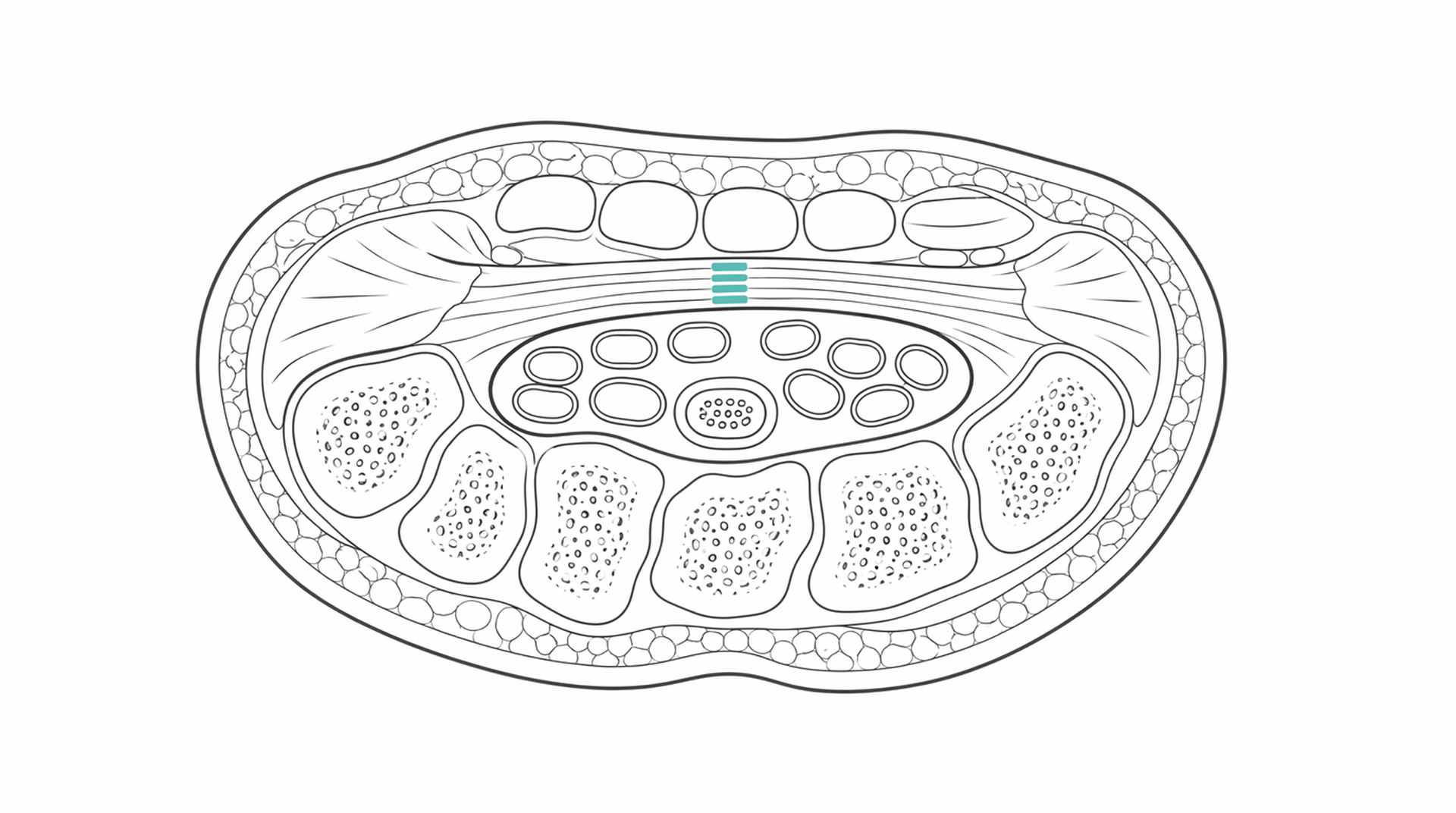 Medical line illustration of carpal tunnel release for Carpal tunnel release.