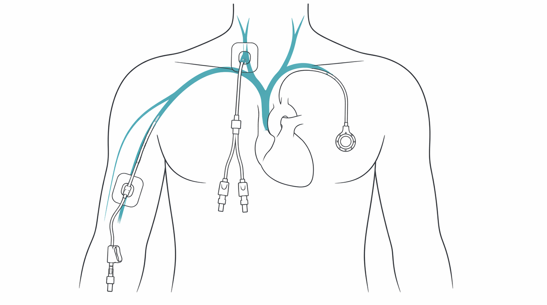 Medical line illustration of central line picc port for Chest port (port-a-cath) insertion.