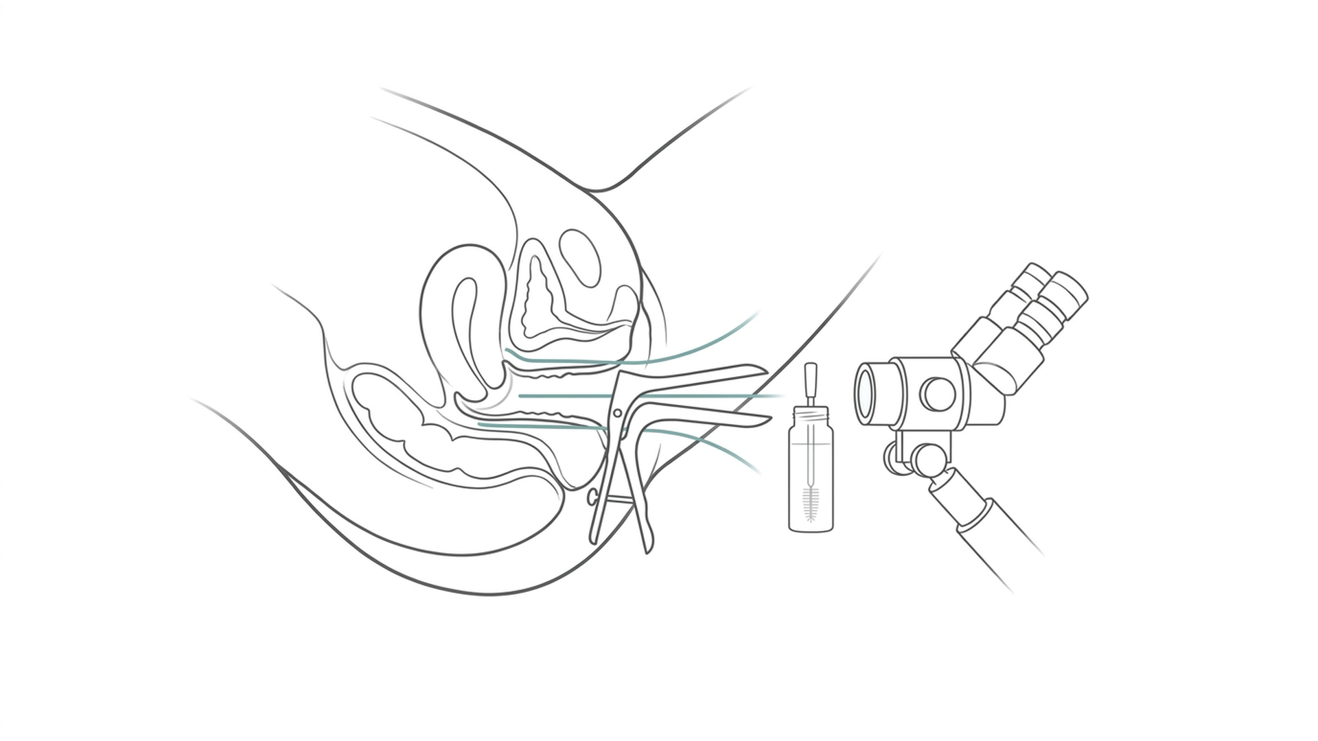 Medical line illustration of cervical screening and colposcopy assessment for Colposcopy.