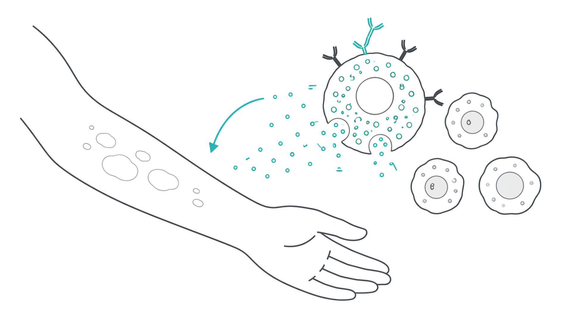 Medical line illustration of chronic urticaria angioedema for Angioedema (deep swelling) assessment.