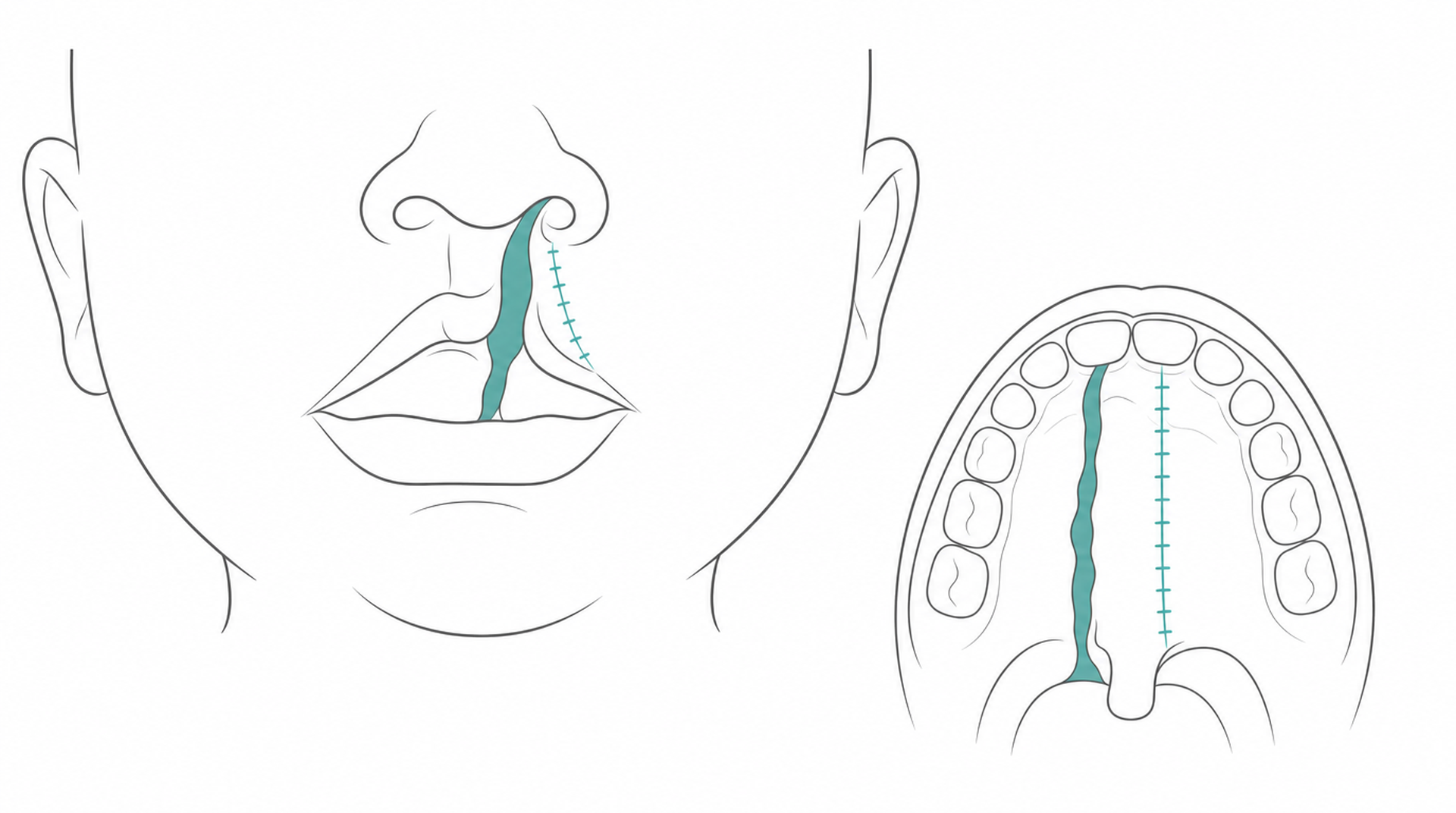 Medical line illustration of cleft lip palate care for Cleft lip and palate surgery.