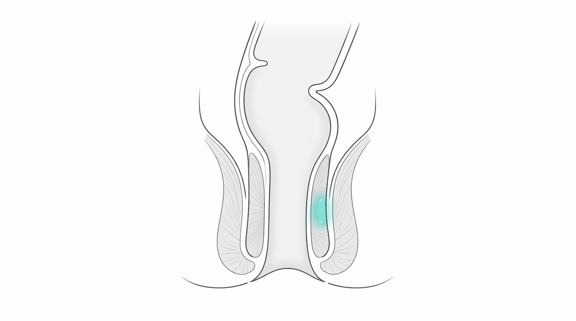 Medical line illustration of lower rectum and anal canal treatment anatomy for Pilonidal sinus surgery.