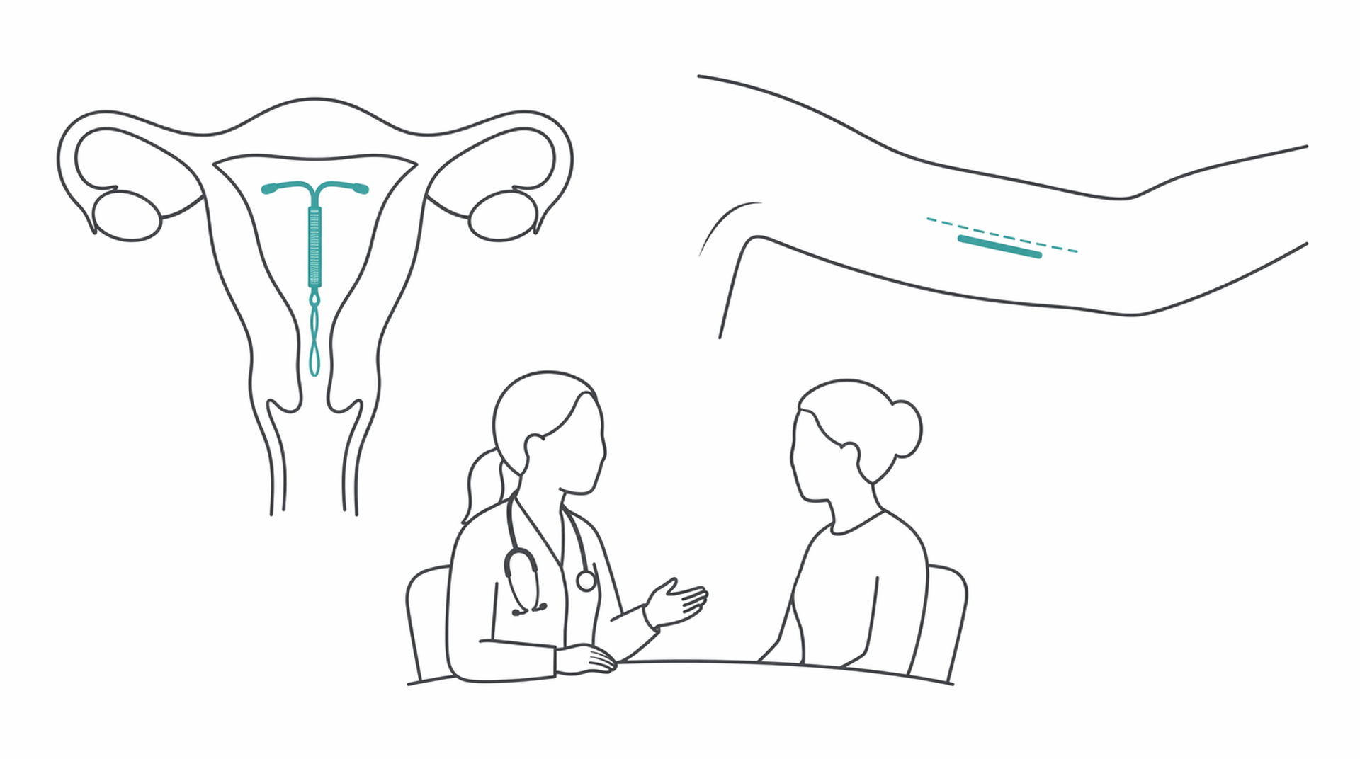 Medical line illustration of contraception coil implant for Coil fitting (IUD/IUS).