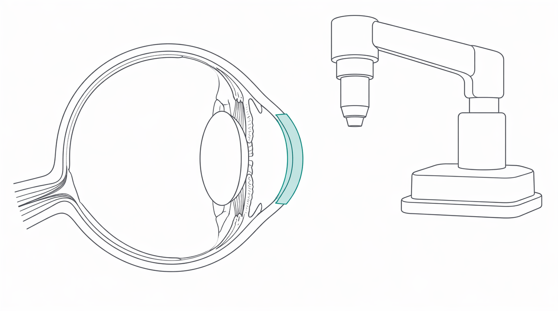 Medical line illustration of corneal transplant laser eye for Corneal transplant.