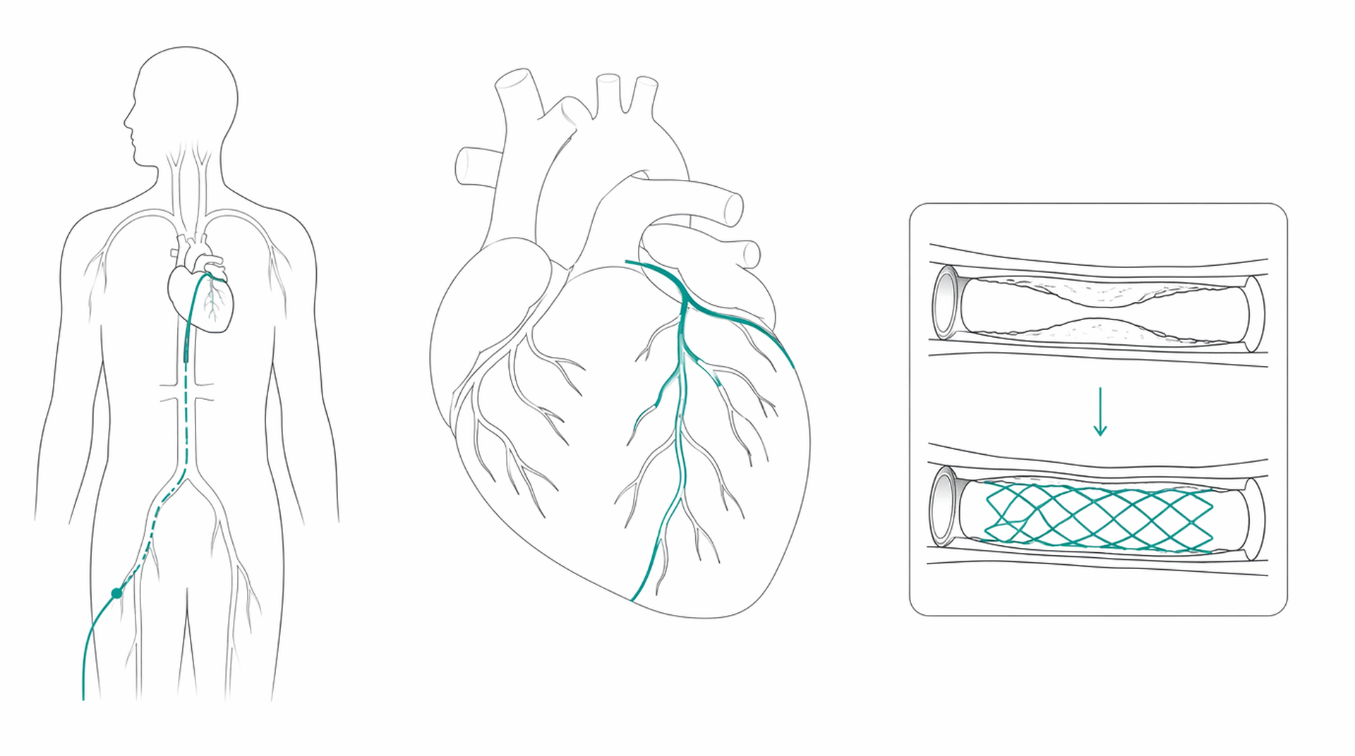 Medical line illustration of coronary angiography stent for Angiogram.