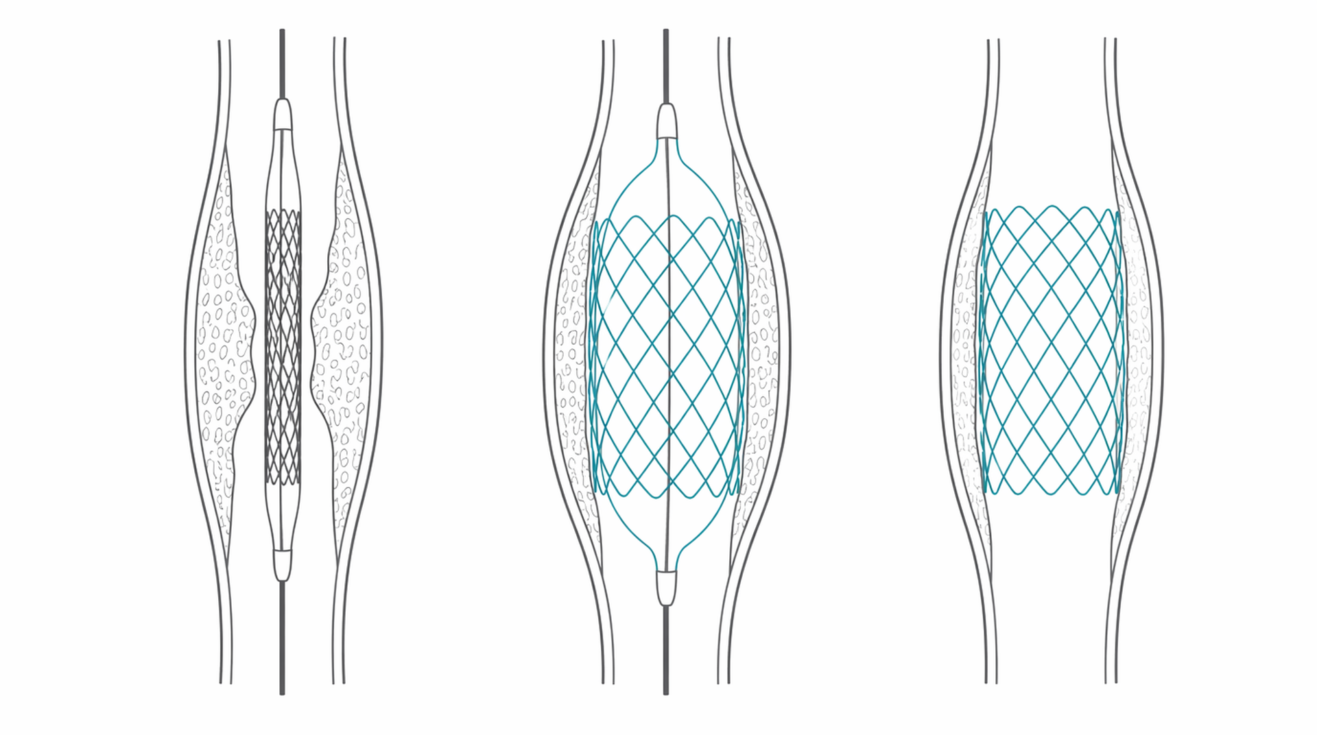 Medical line illustration of coronary stent and balloon angioplasty for Angioplasty and stenting.