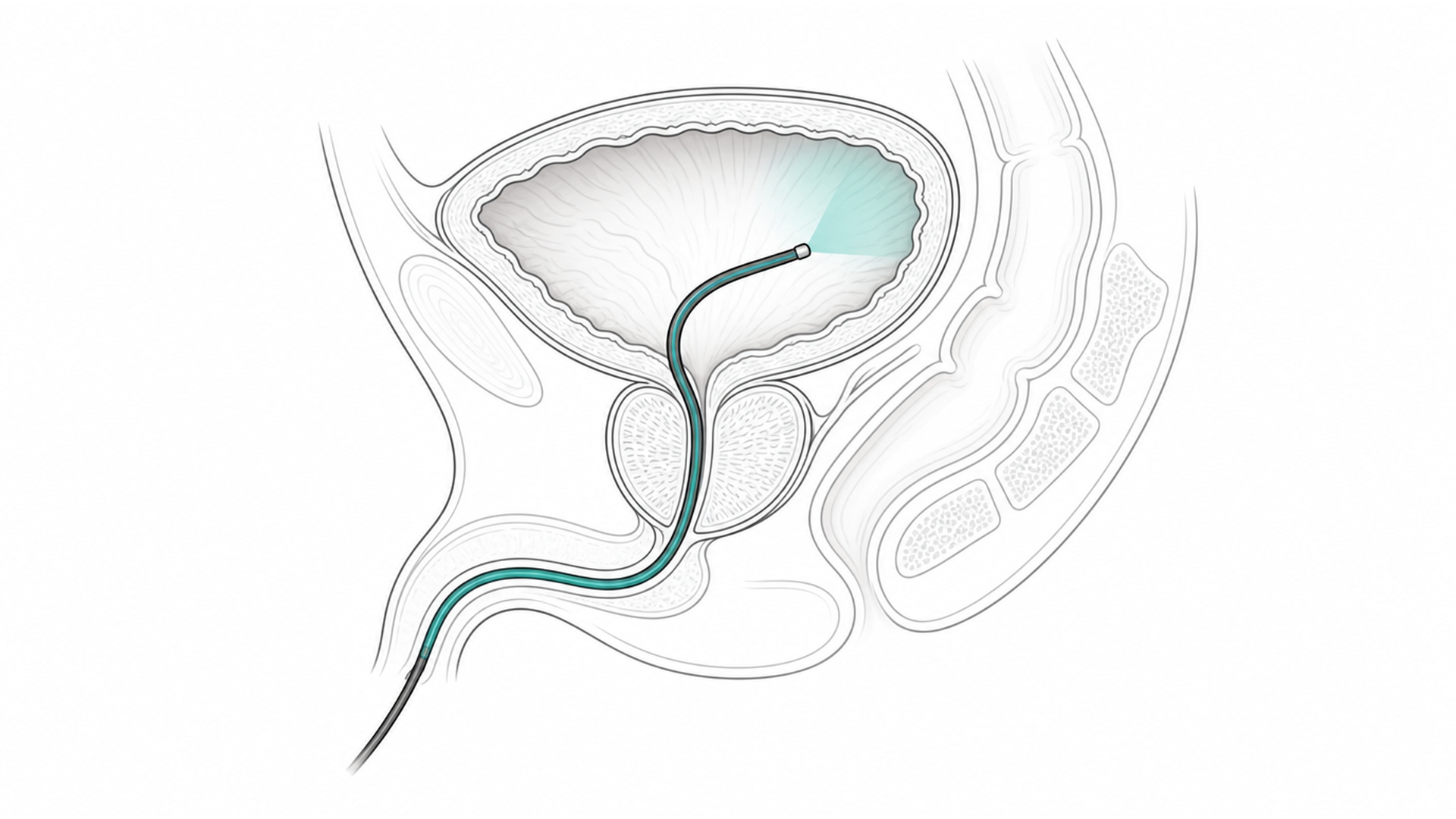 Medical line illustration of cystoscopy bladder prostate for Cystoscopy (bladder telescope).