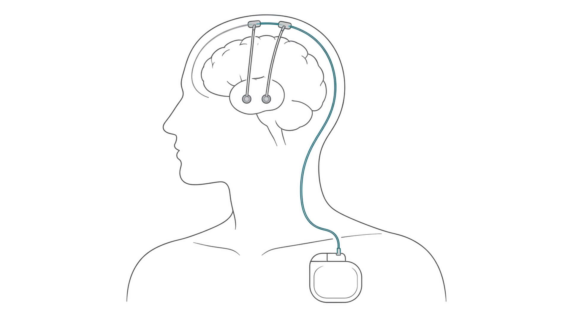 Medical line illustration of deep brain stimulation device for Deep brain stimulation.