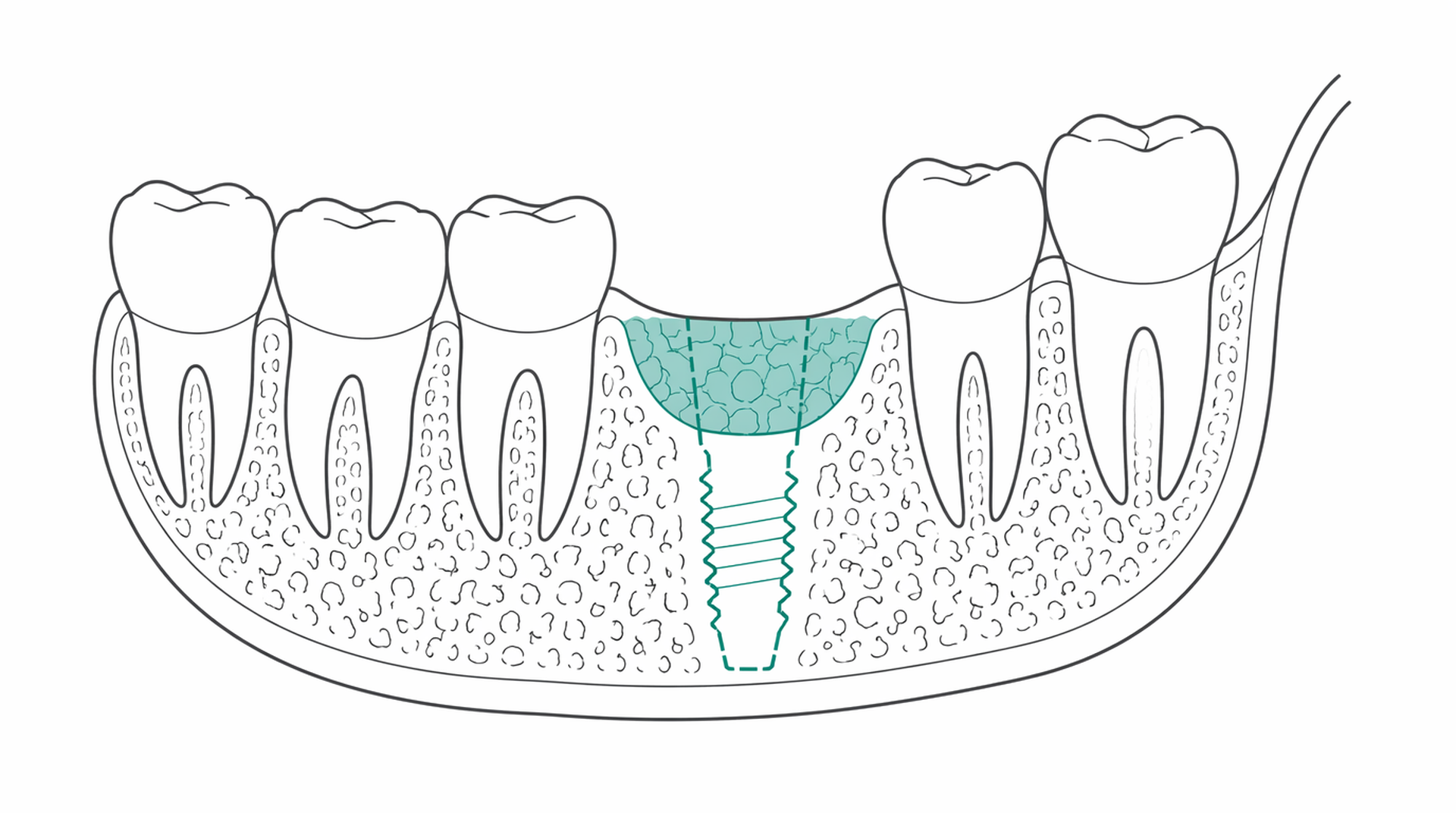 Medical line illustration of dental implant bone graft for Bone grafting for implants.