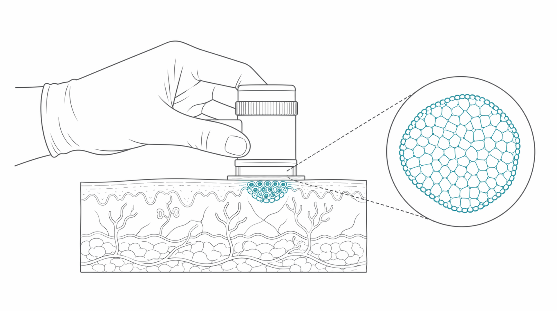 Medical line illustration of dermoscopy mole examination for Skin surveillance (for work-related dermatitis).