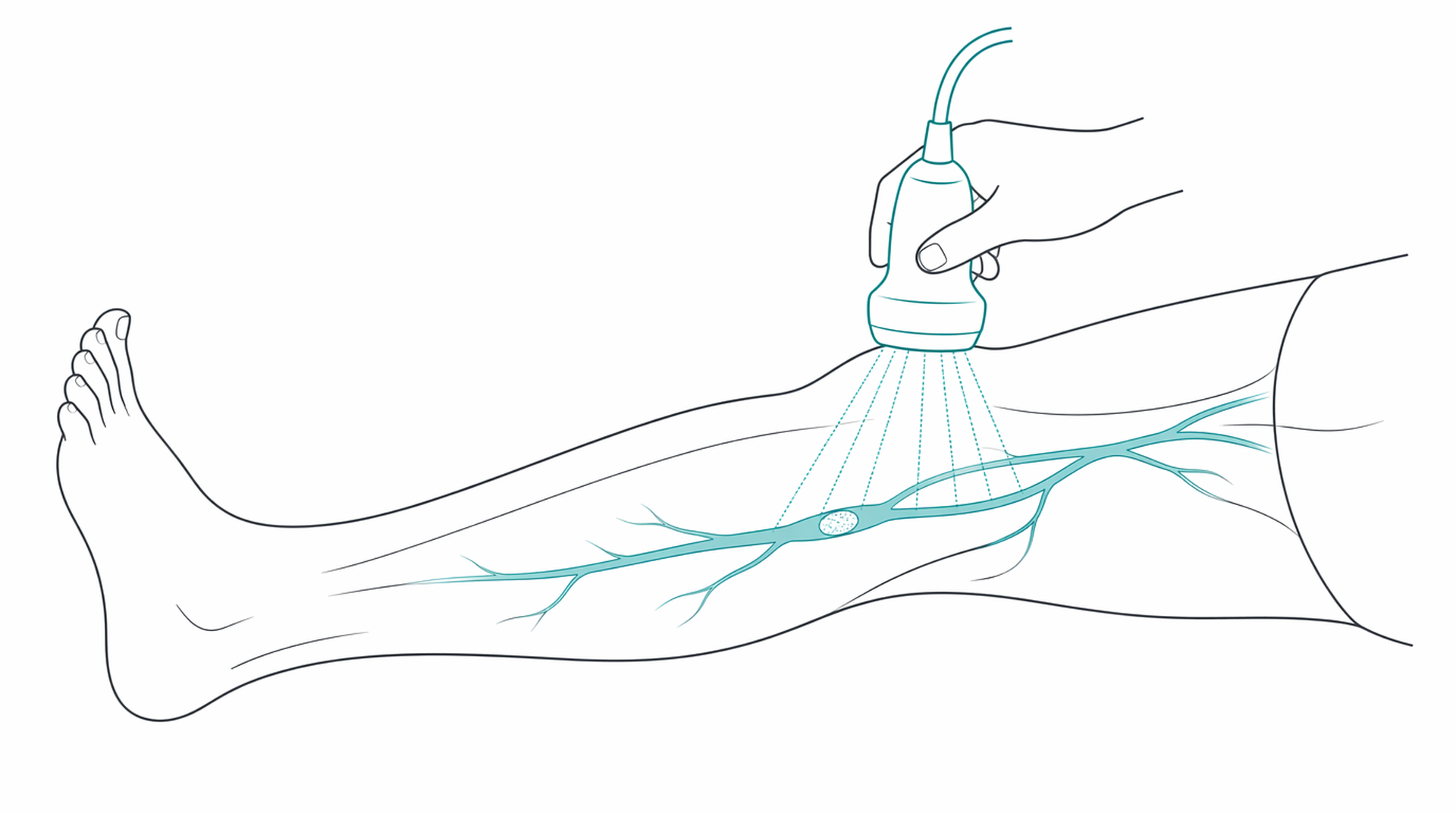 Medical line illustration of dvt leg clot assessment for DVT (blood clot in the leg) assessment.