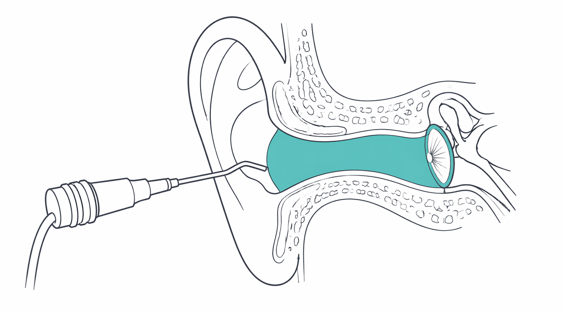 Medical line illustration of ear microsuction eardrum for Tympanometry.
