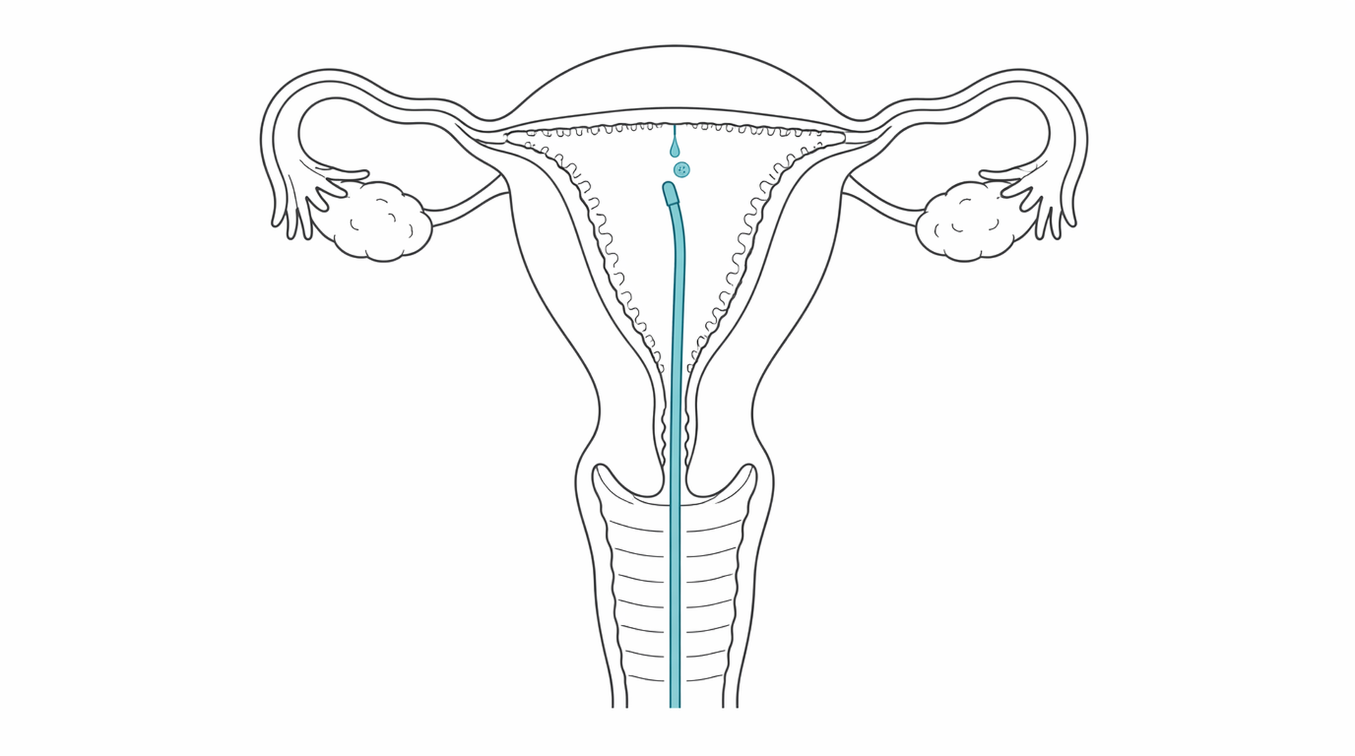 Medical line illustration of embryo transfer catheter for Intrauterine insemination (IUI).