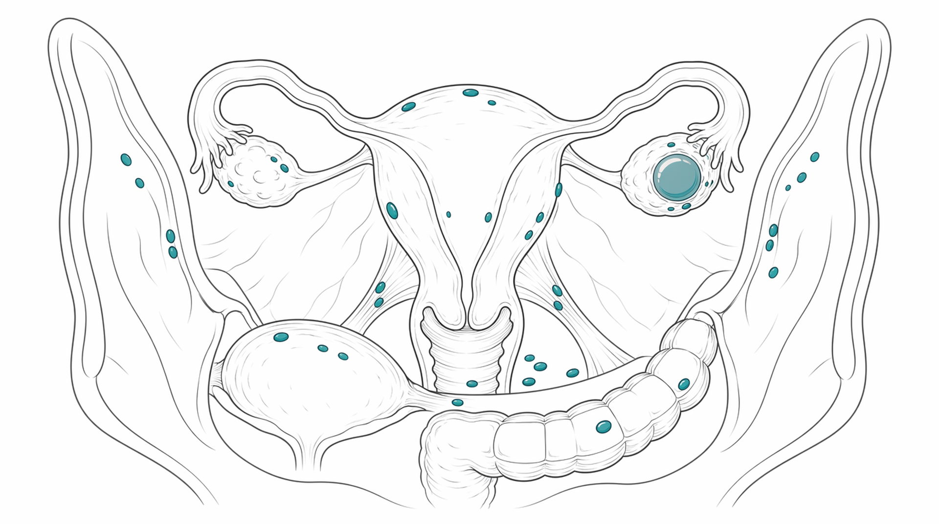 Medical line illustration of endometriosis implant sites for Adenomyosis treatment.