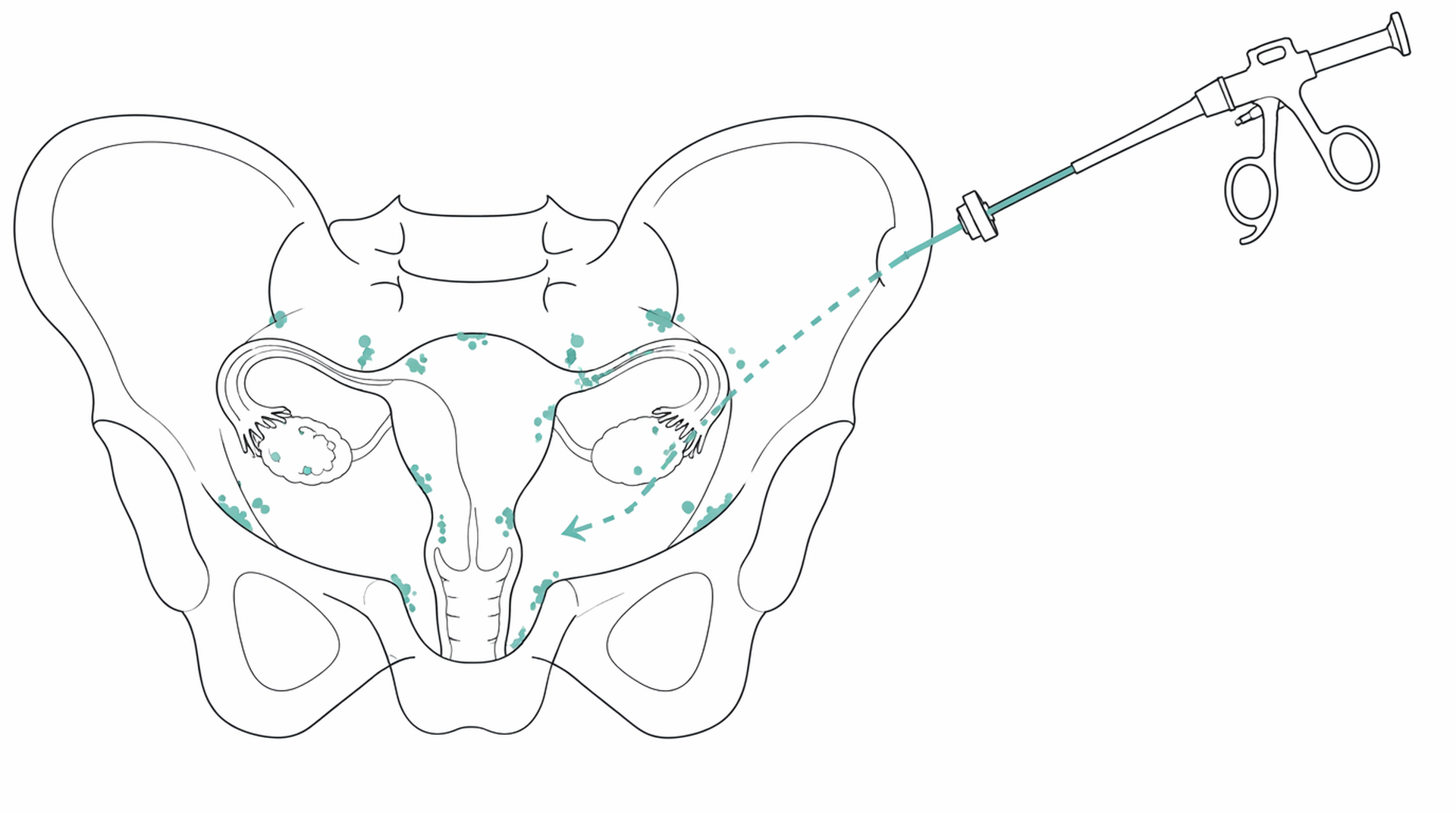 Medical line illustration of endometriosis pelvic pain for Pelvic pain assessment.