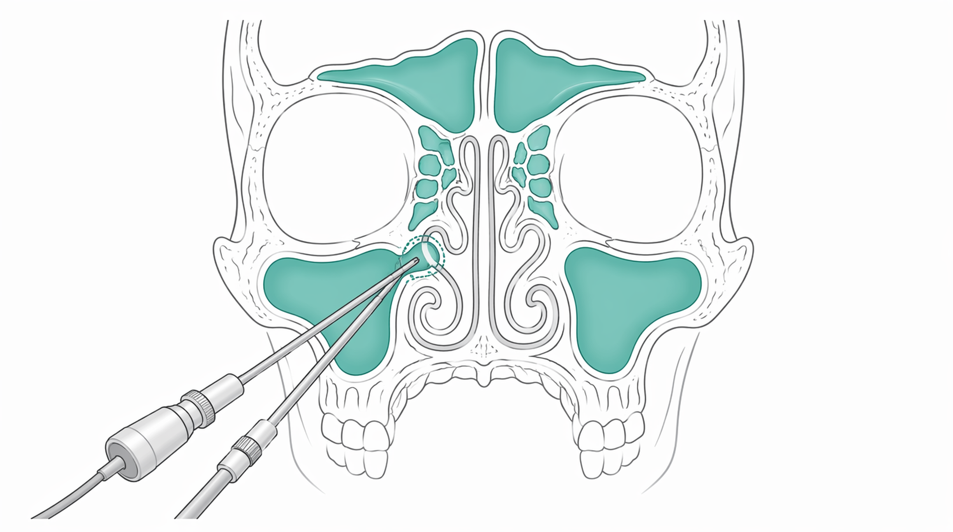 Medical line illustration of endoscopic sinus surgery anatomy for Balloon sinuplasty.