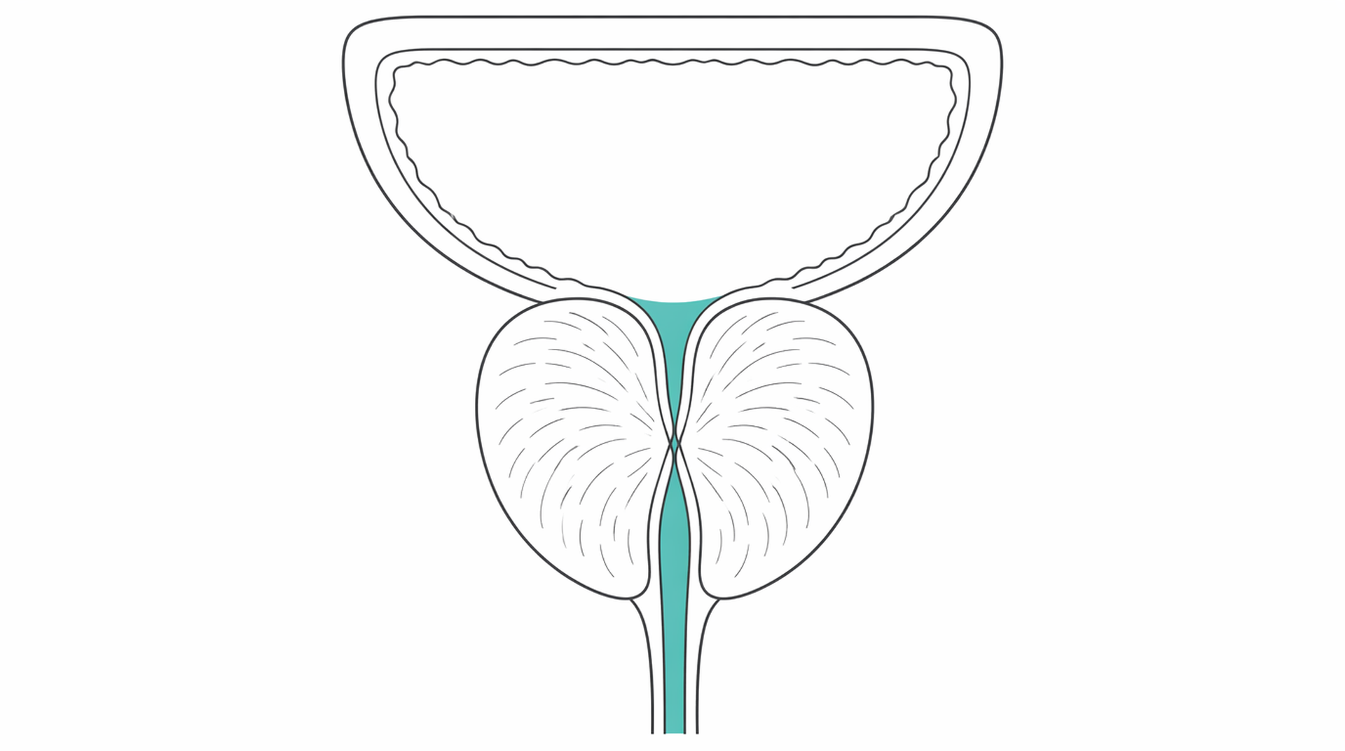 Medical line illustration of enlarged prostate narrowing urethra for Laser prostate surgery (HoLEP / GreenLight).