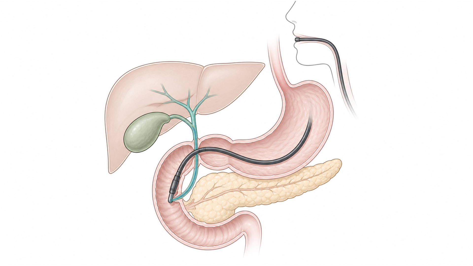 Medical line illustration of the bile duct, pancreas and ERCP pathway for ERCP (bile duct endoscopy).