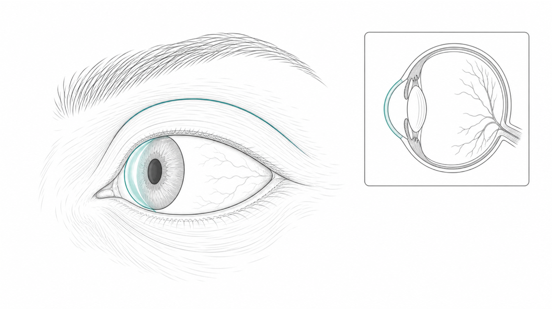 Medical line illustration of the eye, eyelid and orbit for Squint (strabismus) surgery.
