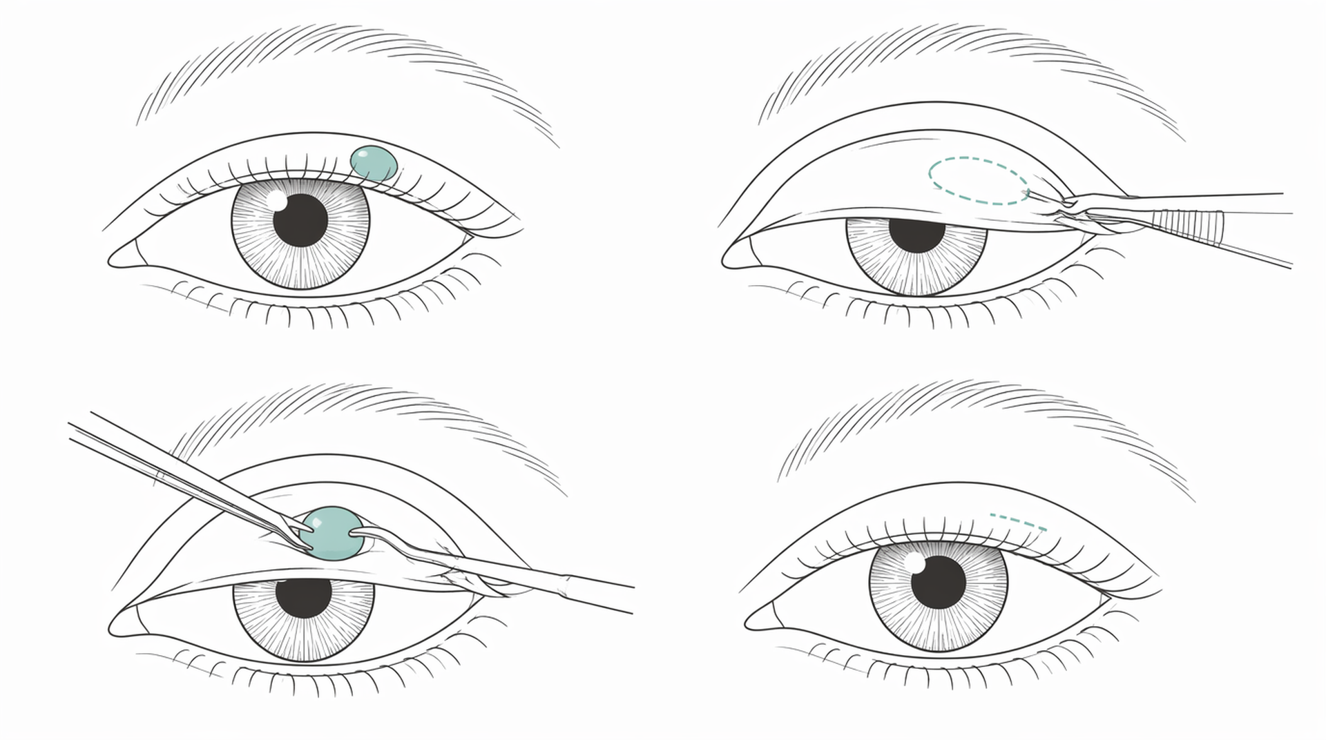 Medical line illustration of eyelid chalazion surgery for Droopy eyelid surgery (ptosis correction).