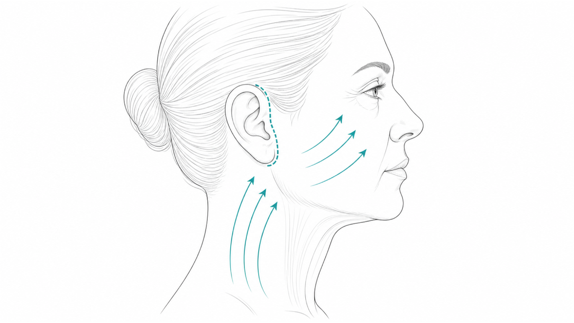 Medical line illustration of the face and neck soft tissues for Cheek augmentation.