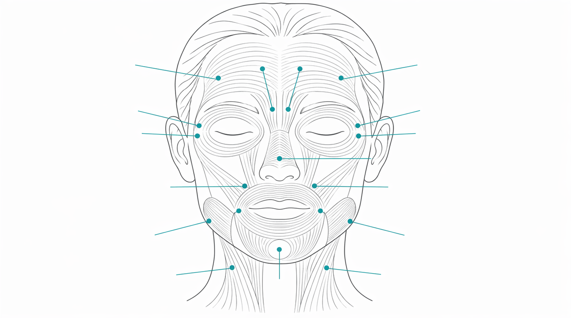 Medical line illustration of facial injectable treatment map for Botox for excessive sweating.