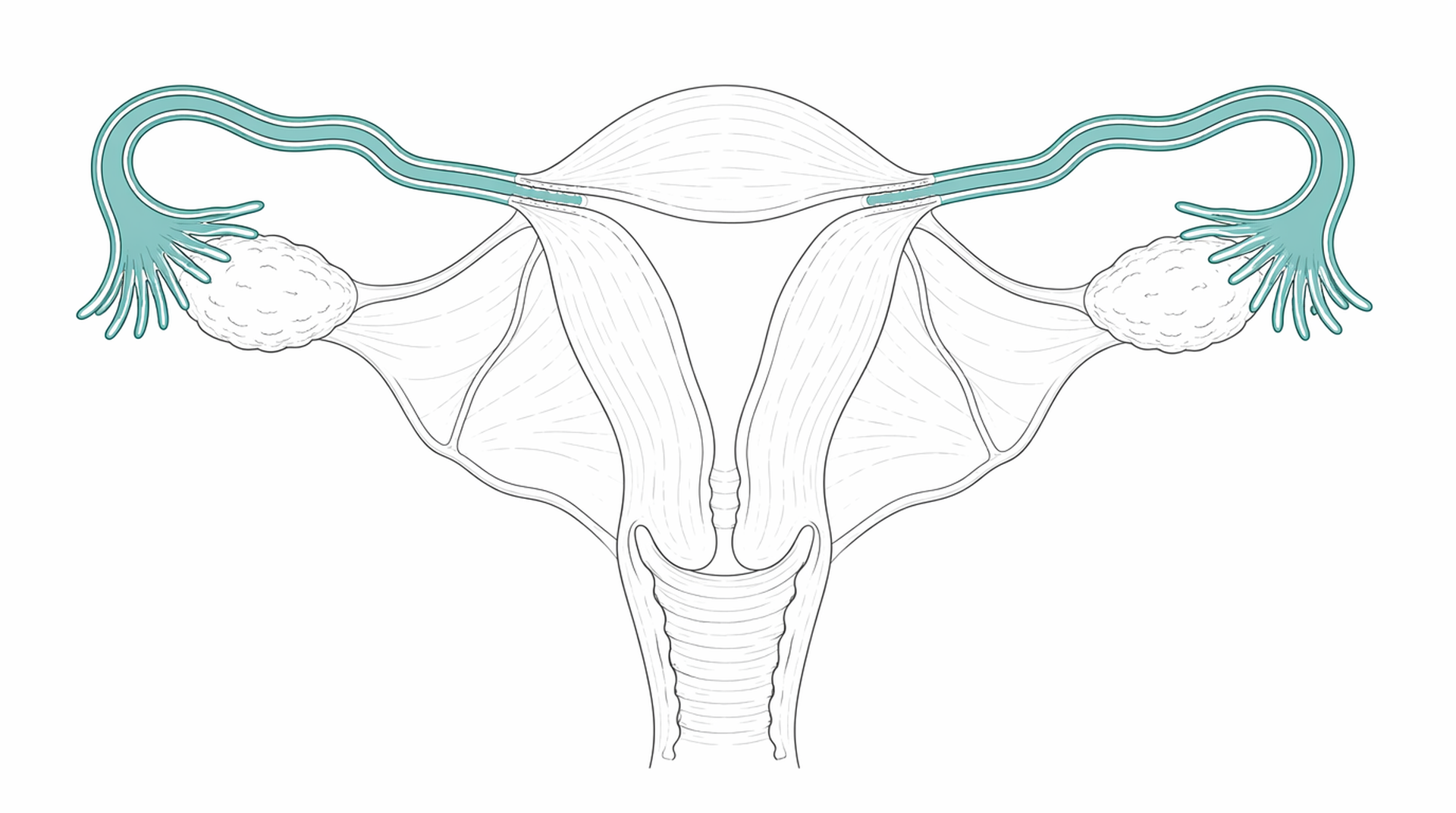 Medical line illustration of fallopian tube anatomy for Ectopic pregnancy care.