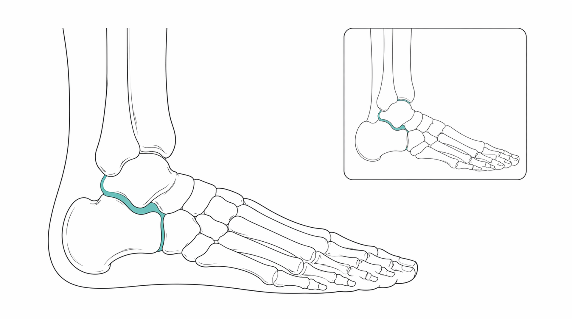 Medical line illustration of foot ankle surgery for Hammer toe correction.
