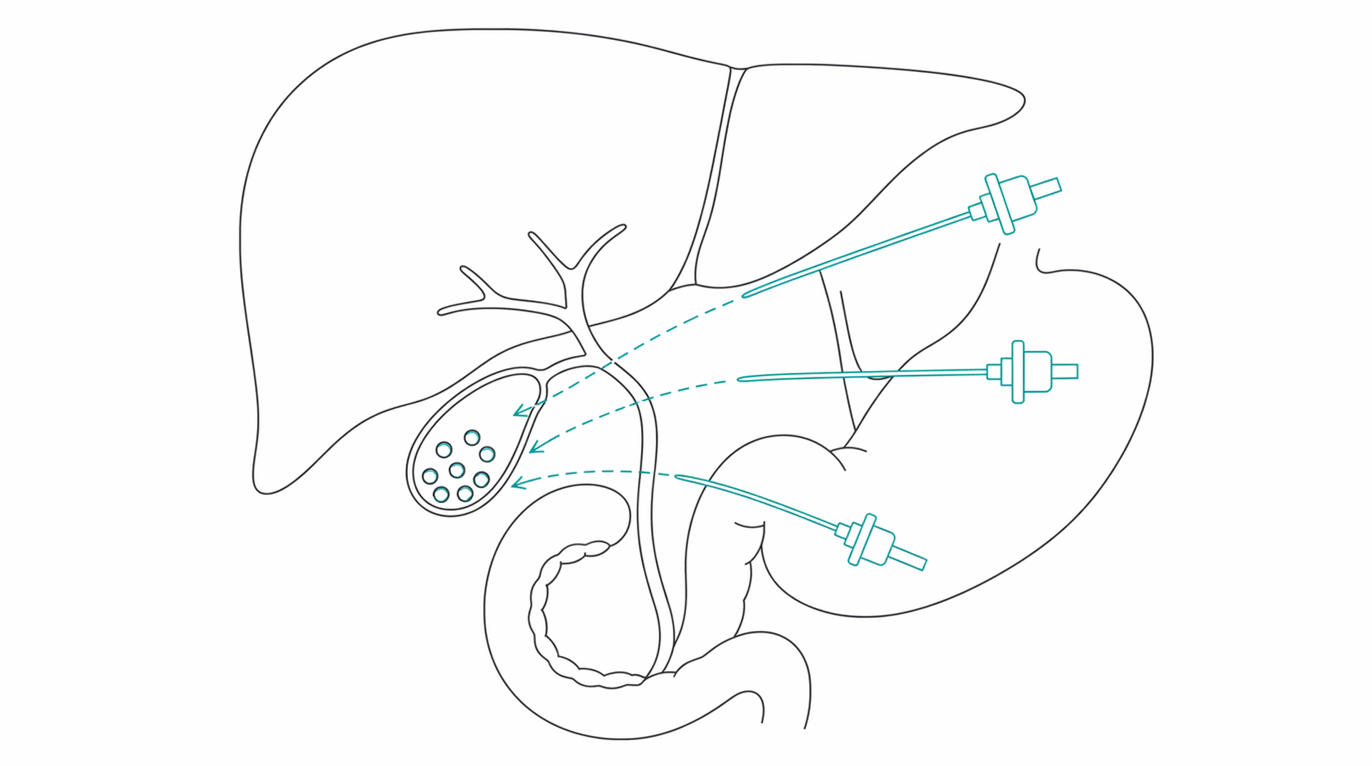 Medical line illustration of gallbladder cholecystectomy for Gallbladder removal (cholecystectomy).